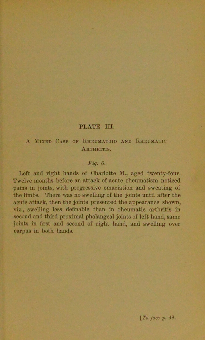 PLATE III. A Mixed Case of Rheumatoid and Rheumatic Arthritis. Fig. 6. Left and right hands of Charlotte M., aged twenty-four. Twelve months before an attack of acute rheumatism noticed pains in joints, with progressive emaciation and sweating of the limbs. There was no swelling of the joints until after the acute attack, then the joints presented the appearance shown, viz., swelling less definable than in rheumatic arthritis in second and third proximal phalangeal joints of left hand, same joints in first and second of right hand, and swelling over carpus in both hands. [To face p. 48,