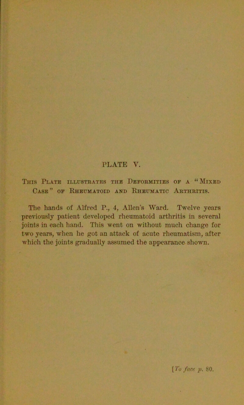 PLATE V. This Plate illustrates the Deformities of a “ Mixed Case” of Rheumatoid and Rheumatic Arthritis. The hands of Alfred P., 4, Allen's Ward. Twelve years previously patient developed rheumatoid arthritis in several joints in each hand. This went on without much change for two years, when he got an attack of acute rheumatism, after which the joints gradually assumed the appearance shown. [ To fare p. 80.