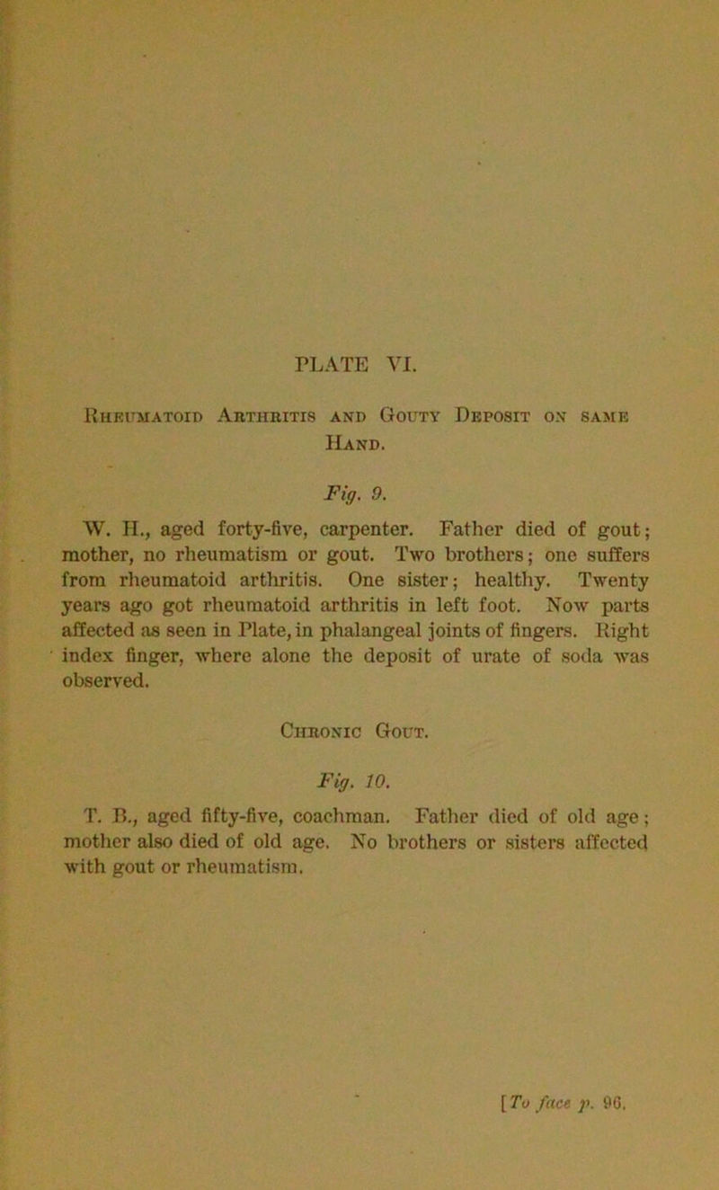 Rheumatoid Arthritis and Gouty Deposit on same Hand. Fig. 9. W. H., aged forty-five, carpenter. Father died of gout; mother, no rheumatism or gout. Two brothers; one suffers from rheumatoid artlrritis. One sister; healthy. Twenty years ago got rheumatoid arthritis in left foot. Now parts affected as seen in Plate, in phalangeal joints of fingers. Right index finger, where alone the deposit of urate of soda was observed. Chronic Gout. Fig. 10. T. B., aged fifty-five, coachman. Father died of old age; mother also died of old age. No brothers or sisters affected with gout or rheumatism. f To face p. 96,
