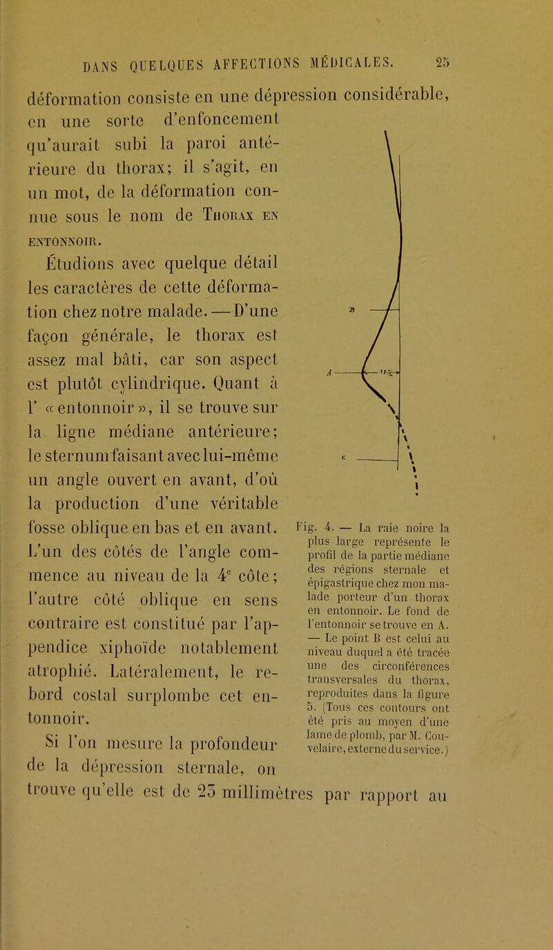 déforniDtion consiste en une dépression considérable, en une sorte d’enfoncement qu’aurait subi la paroi anté- rieure du thorax; il s’agit, en un mot, de la déformation con- nue sous le nom de Thorax en ENTONNOIR. Étudions avec quelque détail les caractères de cette déforma- tion chez notre malade. — D’une façon générale, le thorax est assez mal bâti, car son aspect est plutôt cylindrique. Quant à r «entonnoir», il se trouve sur la ligne médiane antérieure; le sternum faisant avec lui-même un angle ouvert en avant, d’où la production d’une véritable fosse oblique en bas et en avant, i/un des côtés de l’angle com- mence au niveau de la 4 côte; l’autre côté oblique en sens contraire est constitué par l’ap- pendice xiphoïde notablement atrophié. Latéralement, le re- bord costal surplombe cet en- tonnoir. Si l’on mesure la profondeur de la dépression sternale, on tiouve qu elle est de 25 millimètres par rapport au Fig. 4. — La raie noire la plus large représente le profil de la partie médiane des régions sternale et épigastrique chez mon ma- lade porteur d’un thorax en entonnoir. Le fond de l’entonnoir se trouve en A. — Le point B est celui au niveau duquel a été tracée une des circonférences transversales du thorax, reproduites dans la figure 5. (Tous ces contours ont été pris au moyen d’une lame de plomb, par JL Cou- velaire, externe du service. )