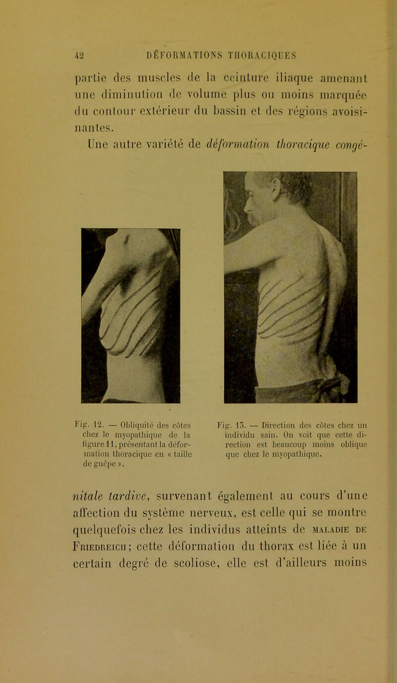 partie des muscles de la ceinture iliaque amenant une diminution de volume plus ou moins marquée du contour extérieur du bassin et des régions avoisi- nantes. Une autre variété de déformation thoracique congé- Fig. 12. — Obliquité des côtes cliez le myopatliique de la figure 11, présentant la défor- mation thoracique en a taille de guêpe ». Fig. lô. — Direction des cotes chez un individu sain. On voit que cette di- rection est beaucoup moins oblique que chez le myopatliique. nitale tardive, survenant également au cours d’une allection du système nerveux, est celle qui se montre quelquefois chez les individus atteints de mal.\die de FniEDnEicii; cette déformation du thorax est liée à un certain degré de scoliose, elle est d’ailleurs moins