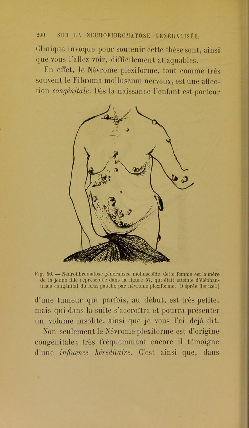 ('Unique invoque pour soutenir cette thèse sont, ainsi que vous l’allez voir, difficilement attaquables. En effet, le INévrome plexiforme, tout comme très souvent le Fibroma molluscum nerveux, est une affec- tion congénitale. Dès la naissance l’enfant est porteur Fig. 56. — Neurofibromatose généralisée molluscoïde. Cette femme est la mère de la jeune fille représentée dans la ligure 57, qui était atteinte d’éléphan- liasis congénital du bras gauche par névrome plexiforme. (D après llerczel.) d’une tumeur qui parfois, au début, est très petite, mais qui dans la suite s’accroîtra et pourra présenter un volume insolite, ainsi que je vous l’ai déjà dit. Non seulement le Névrome plexiforme est d’origine congénitale; très fréquemment encore il témoigne d’une influence héréditaire. C’est ainsi que, dans