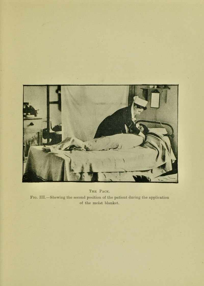 Fig. III.—Shewing the second position of the patient during the application of the moist blanket.