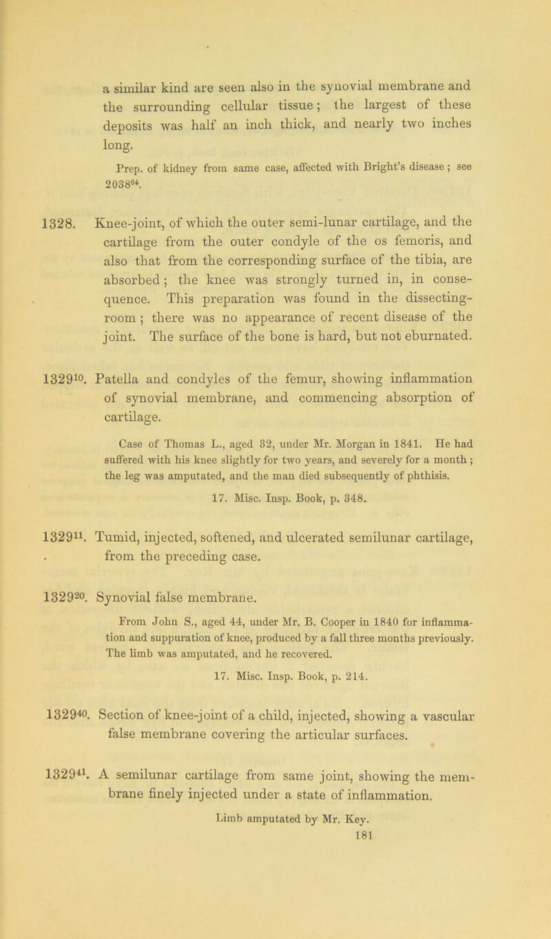a similar kind are seen also in the synovial membrane and the surrounding cellular tissue; the largest of these deposits was half an inch thick, and nearly two inches long. Prep, of kidney from same case, affected with Bright’s disease; see 203864. 1328. Knee-joint, of which the outer semi-lunar cartilage, and the cartilage from the outer condyle of the os femoris, and also that from the corresponding surface of the tibia, are absorbed; the knee was strongly turned in, in conse- quence. This preparation was found in the dissecting- room ; there was no appearance of recent disease of the joint. The surface of the bone is hard, but not eburnated. 132910. Patella and condyles of the femur, showing inflammation of synovial membrane, and commencing absorption of cartilage. Case of Thomas L., aged 32, under Mr. Morgan in 1841. He had suffered with his knee slightly for two years, and severely for a month ; the leg was amputated, and the man died subsequently of phthisis. 17. Misc. Insp. Book, p. 348. 132911. Tumid, injected, softened, and ulcerated semilunar cartilage, from the preceding case. 1329-°. Synovial false membrane. From John S., aged 44, under Mr. B. Cooper in 184(1 for inflamma- tion and suppuration of knee, produced by a fall three months previously. The limb was amputated, and he recovered. 17. Misc. Insp. Book, p. 214. 13294<>. Section of knee-joint of a child, injected, showing a vascular false membrane covering the articular surfaces. 132941. A semilunar cartilage from same joint, showing the mem- brane finely injected under a state of inflammation. Limb amputated by Mr. Key.