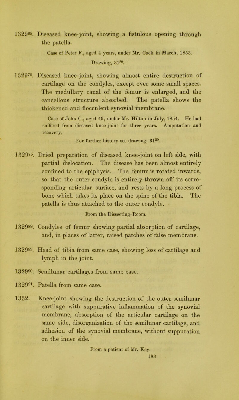 1329^. Diseased knee-joint, showing a fistulous opening through the patella. Case of Peter F., aged 4 years, under Mr. Cock in March, 1853. Drawing, 31^. 13297*^. Diseased knee-joint, showing almost entire destruction of cartilage on the condyles, except over some small spaces. The medullary canal of the femur is enlarged, and the cancellous structure absorbed. The patella shows the thickened and flocculent synovial membrane. Case of John C., aged 49, under Mr. Hilton in July, 1854. He had suffered from diseased knee-joint for three years. Amputation and recovery. For further history see drawing, 31^0. 132975, Dried preparation of diseased knee-joint on left side, with partial dislocation. The disease has been almost entirely confined to the epiphysis. The femur is rotated inwards, so that the outer condyle is entirely thrown off its corre- sponding articular surface, and rests by a long process of bone which takes its place on the spine of the tibia. The patella is thus attached to the outer condyle. From the Dissecting-Room. 13298®. Condyles of femur showing partial absorption of cartilage, and, in places of latter, raised patches of false membrane. 132989 Head of tibia from same case, showing loss of cartilage and lymph in the joint. 132990. Semilunar cartilages from same case. 1329^1. Patella from same case. 1332. Knee-joint showing the destruction of the outer semilunar cartilage with suppurative inflammation of the synovial membrane, absorption of the articular cartilage on the same side, disorganization of the semilunar cartilage, and adhesion of the synovial membrane, without suppuration on the inner side. From a patient of Mr. Key.