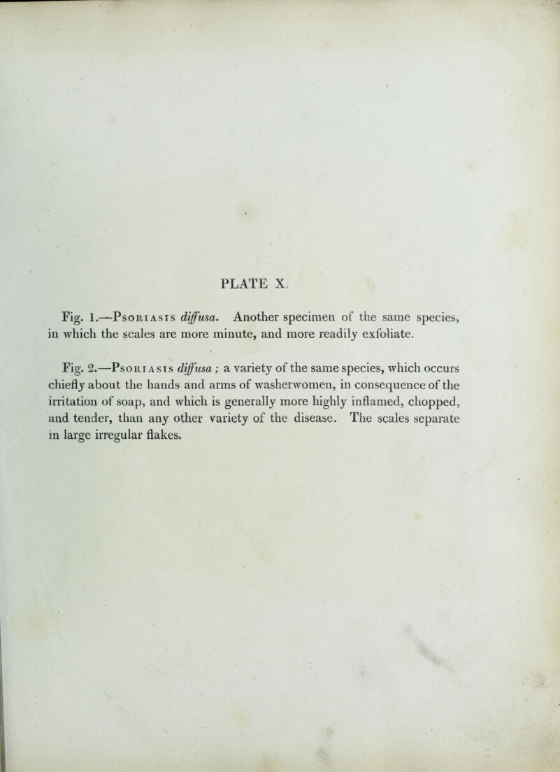 Fig. 1.—Psoriasis diffusa. Another specimen of the same species, in which the scales are more minute, and more readily exfoliate. . t Fig. 2.—Psoriasis diffusa; a variety of the same species, which occurs chiefly about the hands and arms of washerwomen, in consequence of the irritation of soap, and which is generally more highly inflamed, chopped, and tender, than any other variety of the disease. The scales separate in large irregular flakes.