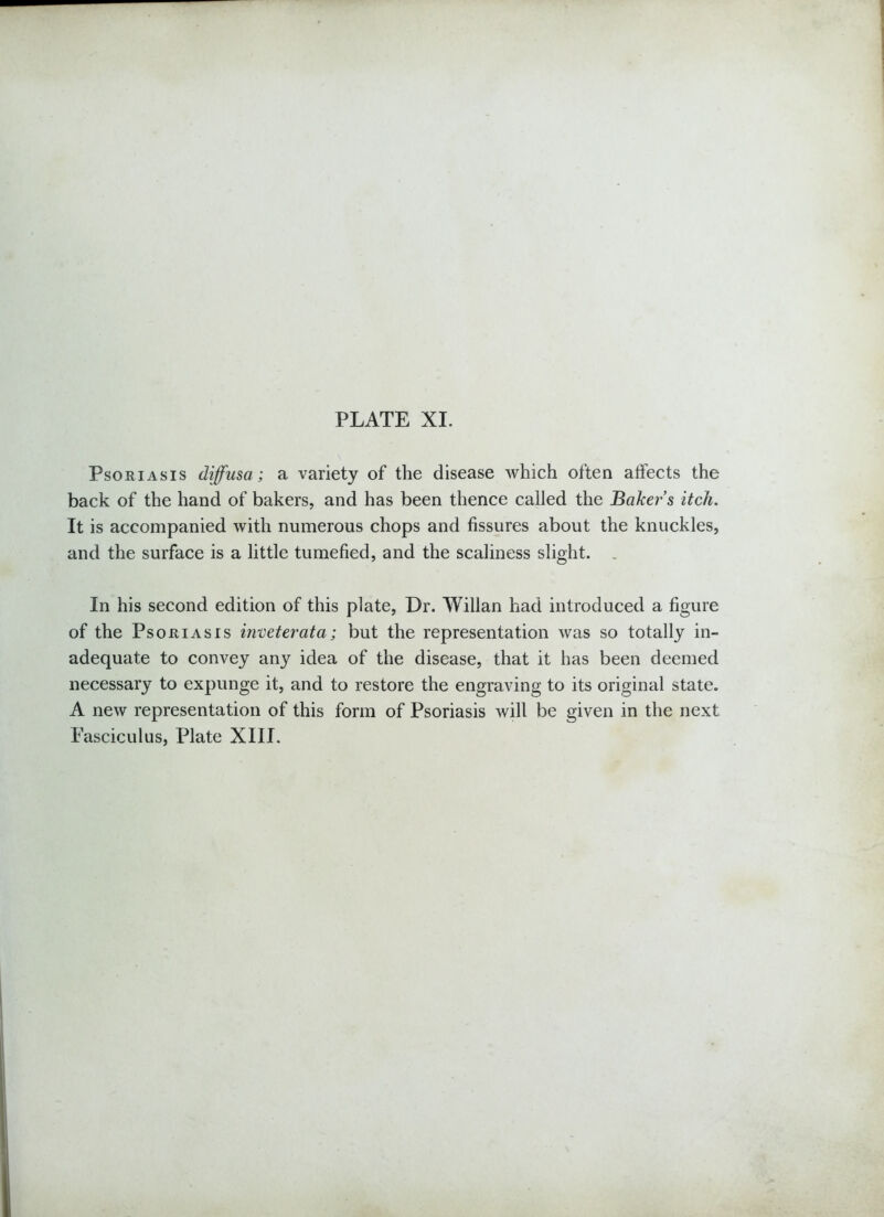 Psoriasis diffusa; a variety of the disease which often affects the back of the hand of bakers, and has been thence called the Baker s itch. It is accompanied with numerous chops and fissures about the knuckles, and the surface is a little tumefied, and the scaliness slight. . In his second edition of this plate, Dr. Willan had introduced a figure of the Psoriasis inveterata; but the representation was so totally in- adequate to convey any idea of the disease, that it has been deemed necessary to expunge it, and to restore the engraving to its original state. A new representation of this form of Psoriasis will be given in the next Fasciculus, Plate XIII.