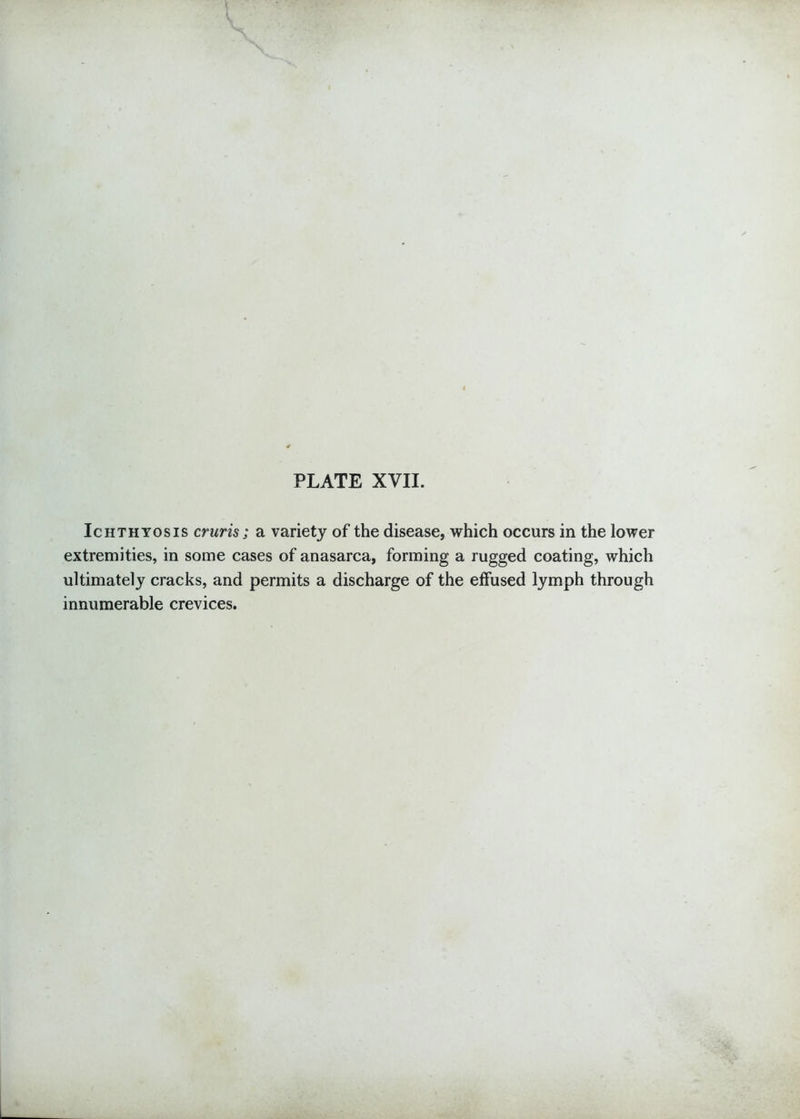 Ichthyosis cruris; a variety of the disease, which occurs in the lower extremities, in some cases of anasarca, forming a rugged coating, which ultimately cracks, and permits a discharge of the effused lymph through innumerable crevices.