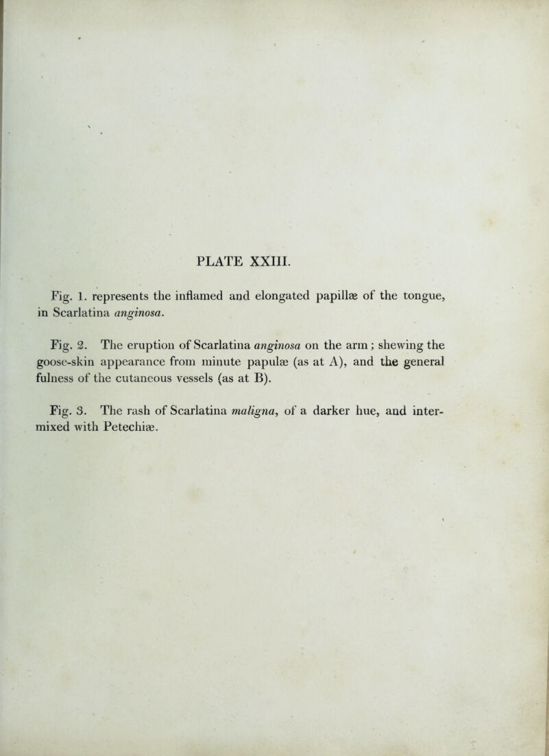 Fig. 1. represents the inflamed and elongated papillae of the tongue, in Scarlatina anginosa. Fig. 2. The eruption of Scarlatina anginosa on the arm; shewing the goose-skin appearance from minute papulae (as at A), and the general fulness of the cutaneous vessels (as at B). Fig. 3. The rash of Scarlatina maligna, of a darker hue, and inter- mixed with Petechiae.