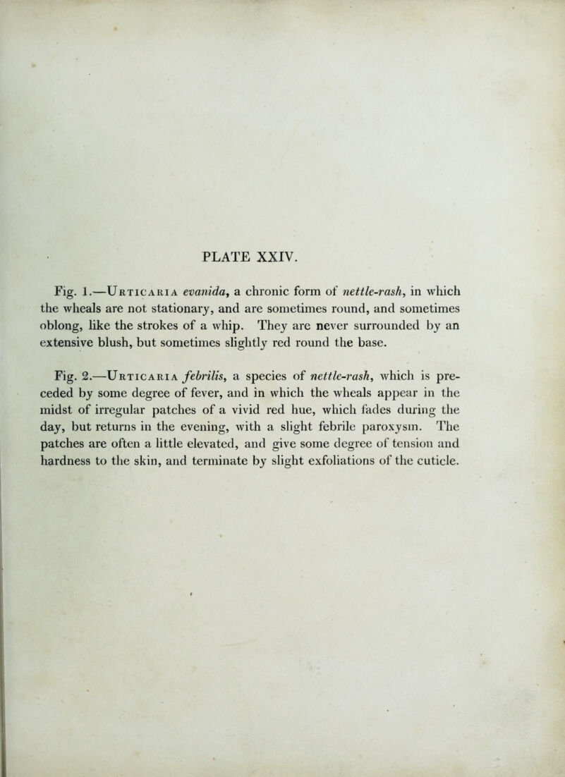 Fig. 1.—Urticaria evanida, a chronic form of nettle-rash, in which the wheals are not stationary, and are sometimes round, and sometimes oblong, like the strokes of a whip. They are never surrounded by an extensive blush, but sometimes slightly red round the base. Fig. 2.—Urticaria febrilis, a species of nettle-rash, which is pre- ceded by some degree of fever, and in which the wheals appear in the midst of irregular patches of a vivid red hue, which fades during the day, but returns in the evening, with a slight febrile paroxysm. The patches are often a little elevated, and give some degree of tension and hardness to the skin, and terminate by slight exfoliations of the cuticle.