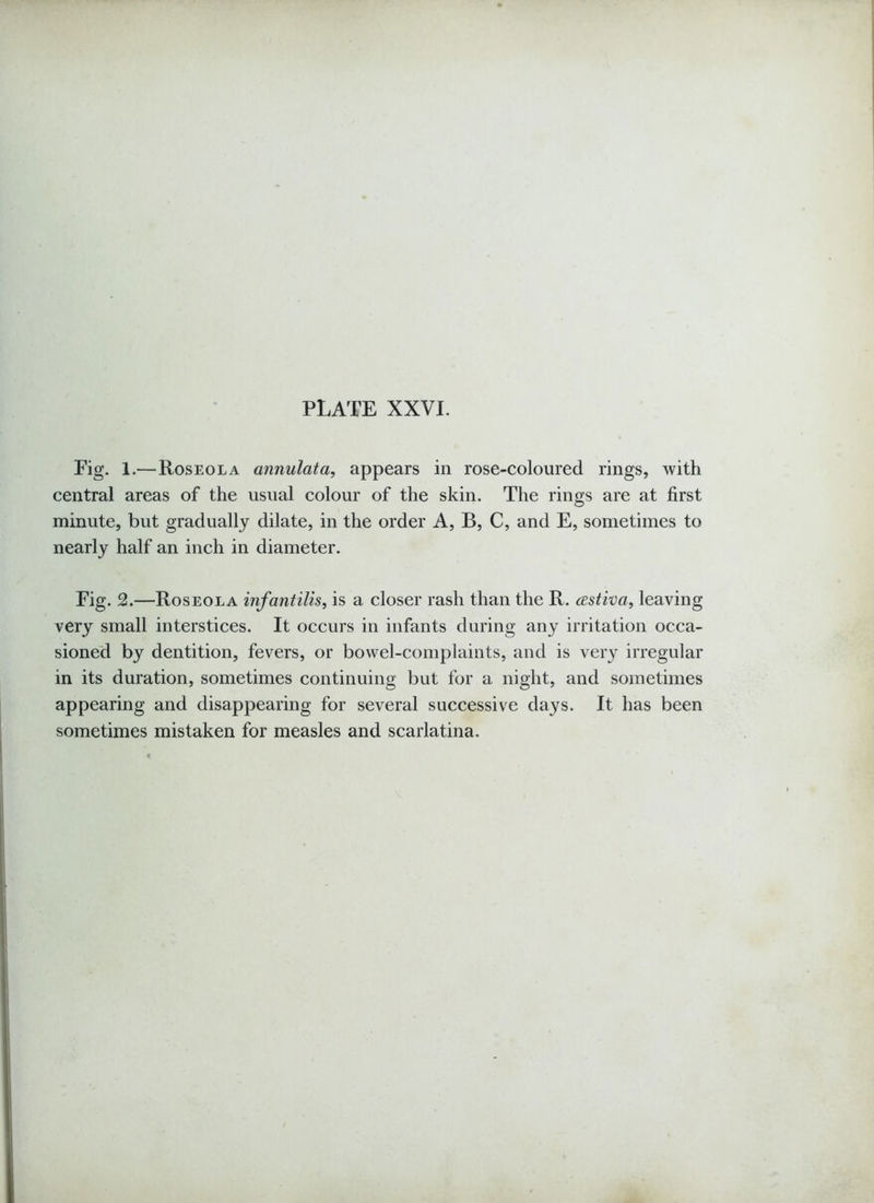Eig. 1.—Roseola annulata, appears in rose-coloured rings, with central areas of the usual colour of the skin. The rings are at first minute, but gradually dilate, in the order A, B, C, and E, sometimes to nearly half an inch in diameter. Eig. 2.—Roseola infantilis, is a closer rash than the R. (estiva, leaving very small interstices. It occurs in infants during any irritation occa- sioned by dentition, fevers, or bowel-complaints, and is very irregular in its duration, sometimes continuing but for a night, and sometimes appearing and disappearing for several successive days. It has been sometimes mistaken for measles and scarlatina.