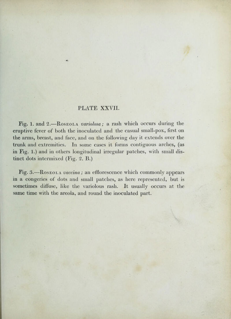 Fig. 1. and 2.—Roseola variolosa; a rash which occurs during the eruptive fever of both the inoculated and the casual small-pox, first on the arms, breast, and face, and on the following day it extends over the trunk and extremities. In some cases it forms contiguous arches, (as in Fig. 1.) and in others longitudinal irregular patches, with small dis- tinct dots intermixed (Fig. 2. B.) Fig. 3.—Roseola vaccina; an efflorescence which commonly appears in a congeries of dots and small patches, as here represented, but is sometimes diffuse, like the variolous rash. It usually occurs at the same time with the areola, and round the inoculated part.