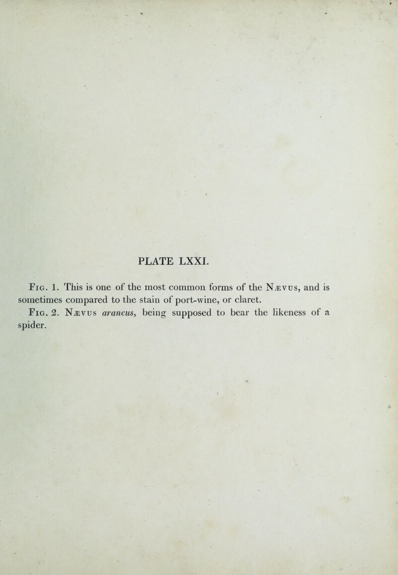 Fig. 1. This is one of the most common forms of the Njevus, and is sometimes compared to the stain of port-wine, or claret. Fig. 2. N^evus araneus, being supposed to bear the likeness of a spider.