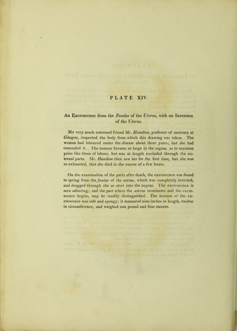 I); PLATE XIV. An Excrescence from the Fundus of the Uterus^ with an Inversion of the Uterus. My veiy much esteemed friend Mr. Hamiltoji, professor of anatomy at Glasgow, inspected the body from which this drawing was taken. The woman had laboured under the disease about three years; but she had concealed it. The tumour became so large in the vagina, as to occasion pains like those of labour, but was at length excluded through the ex- ternal parts. Mr. Hamilton then saw her for the first time, but she was so exhausted, that she died in the course of a few hours. On the examination of the parts after death, the excrescence was found to spring from the fundus of the uterus, which was completely inverted, and dragged through the os uteri into the vagina. The excrescence is seen adhering; and the part where the uterus terminates and the excre- scence begins, may be readily distinguished. The texture of the ex- crescence was soft and spongy; it measured nine inches in length, twelve in circumference, and weighed one pound and four ounces. I ‘ V