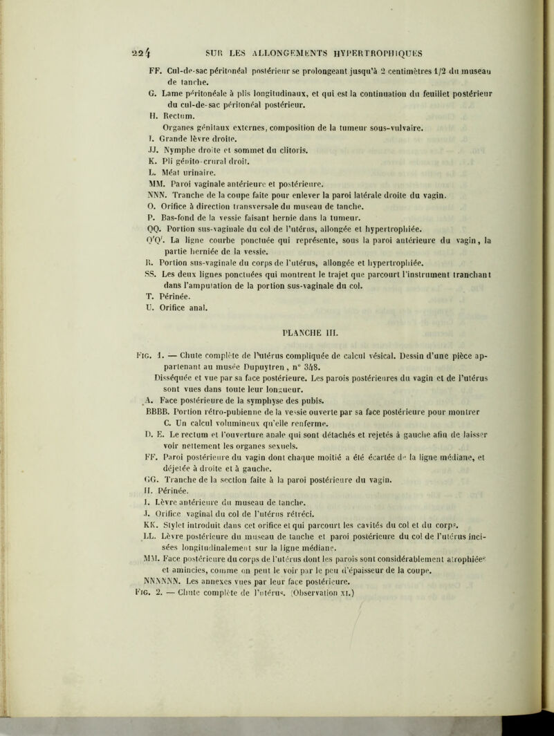 FF. Cul-de-sac péritonéal postérieur se prolongeant jusqu’à 2 centimètres 1/2 du museau de tanrhe. G. Lame péritonéale à plis longitudinaux, et qui est la continuation du feuillet postérieur du cul-de-sac périlonéal postérieur. H. Rectum. Organes génitaux externes, composition de la tumeur sous-vulvaire. L Grande lèvre droite. JJ. Nymphe droite et sommet du clitoris. K. Pli génito-crural droit. L. Méat urinaire. MM. Paroi vaginale antérieure et postérieure. NNN. Tranche de la coupe faite pour enlever la paroi latérale droite du vagin. O. Orifice à direction transversale du museau de tanche. P. Bas-fond de la vessie faisant hernie dans la tumeur. QQ. Portion sus-vaginale du col de l’utérus, allongée et hypertrophiée. O'Q'. La ligne courbe ponctuée qui représente, sous la paroi antérieure du vagin, la partie herniée de la vessie. R. Portion sus-vaginale du corps de l’utérus, allongée et hypertrophiée. SS. Les deux lignes ponctuées qui montrent le trajet que parcourt l'instrument tranchant dans l’ampuiation de la portion sus-vaginale du col. T. Périnée. U. Orifice anal. PLANCHE III. Fig. 1. — Chute complète de l\itérus compliquée de calcul vésical. Dessin d’une pièce ap- partenant au musée Dupuytren, n 3A8. Disséquée et vue par sa face postérieure. Les parois postérieures du vagin et de l’utérus sont vues dans toute leur longueur. A. Face postérieure de la symphyse des pubis. BBBB. Portion rétro-pubienne de la vessie ouverte par sa face postérieure pour montrer C. Un calcul volumineux qu’elle renferme. D. E. Le rectum et l’ouverture anale qui sont détachés et rejetés à gauche afin de laisser voir neltement les organes sexuels. FF. Paroi postérieure du vagin dont chaque moitié a été écartée de la ligne médiane, et déjetée à droite et à gauche. GG. Tranche de la section faite à la paroi postérieure du vagin. H. Périnée. J. Lèvre antérieure du museau de tanche. J. Orifice vaginal du col de l’utérus rétréci. KK. Stylet introduit dans cet orifice et qui parcourt les cavités du col et du corps. LL. Lèvre postérieure du museau de tanche et paroi postérieure du colde l’utérus inci- sées longitudinalement sur la ligne médiane. MM. Face postérieure du corps de l'utérus dont les parois sont considérablement atrophiée? et amincies, comme on peut le voir par le peu d’épaisseur de la coupe. NNNNNN. Les annexes vues par leur face postérieure. Fig. 2. — Chute complète de l’utérus. (Observation xi.)