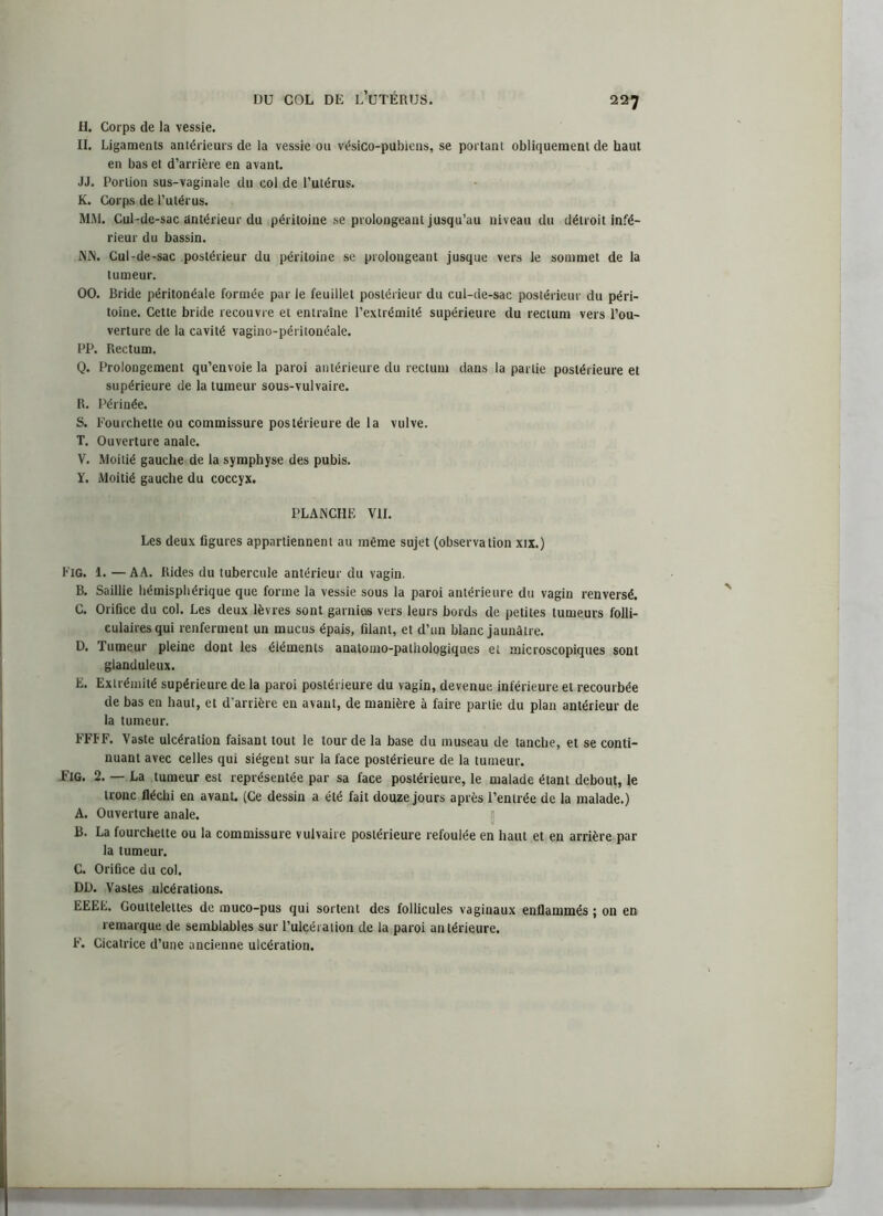 H. Corps de la vessie. II. Ligaments antérieurs de la vessie ou vésico-pubiens, se portant obliquement de haut en bas et d’arrière en avant. JJ. Portion sus-vaginale du col de l’utérus. K. Corps de l’utérus. MM. Cul-de-sac antérieur du péritoine se prolongeant jusqu’au niveau du détroit infé- rieur du bassin. NJS. Cul-de-sac postérieur du péritoine se prolongeant jusque vers le sommet de la tumeur. 00. Bride péritonéale formée par le feuillet postérieur du cul-de-sac postérieur du péri- toine. Cette bride recouvre et entraîne l’extrémité supérieure du rectum vers l’ou- verture de la cavité vagino-péritonéale. PP. Rectum. Q. Prolongement qu’envoie la paroi antérieure du rectum dans la partie postérieure et supérieure de la tumeur sous-vulvaire. R. Périnée. S. Fourchette ou commissure postérieure de la vulve. T. Ouverture anale. V. Moitié gauche de la symphyse des pubis. Y. Moitié gauche du coccyx. PLANCHE VII. Les deux figures appartiennent au même sujet (observation xtx.) Fig. 1. —AA. Rides du tubercule antérieur du vagin. B. Saillie hémisphérique que forme la vessie sous la paroi antérieure du vagin renversé. C. Orifice du col. Les deux lèvres sont garnies vers leurs bords de petites tumeurs folli- culaires qui renferment un mucus épais, filant, et d’un blanc jaunâtre. D. Tumeur pleine dont les éléments anatomo-pathologiques et microscopiques sont glanduleux. E. Extrémité supérieure de la paroi postérieure du vagin, devenue inférieure et recourbée de bas en haut, et d’arrière en avant, de manière à faire partie du plan antérieur de la tumeur. FFFF. Vaste ulcération faisant tout le lourde la base du museau de tanche, et se conti- nuant avec celles qui siègent sur la face postérieure de la tumeur. Fig. 2. — La tumeur est représentée par sa face postérieure, le malade étant debout, le tronc fléchi en avant. (Ce dessin a été fait douze jours après l’entrée de la malade.) A. Ouverture anale. B. La fourchette ou la commissure vulvaire postérieure refoulée en haut et en arrière par la tumeur. C. Orifice du col. DD. Vastes ulcérations. EEEE. Gouttelettes de muco-pus qui sortent des follicules vaginaux enflammés ; on en remarque de semblables sur l’ulçéiation de la paroi antérieure. F. Cicatrice d’une ancienne ulcération.