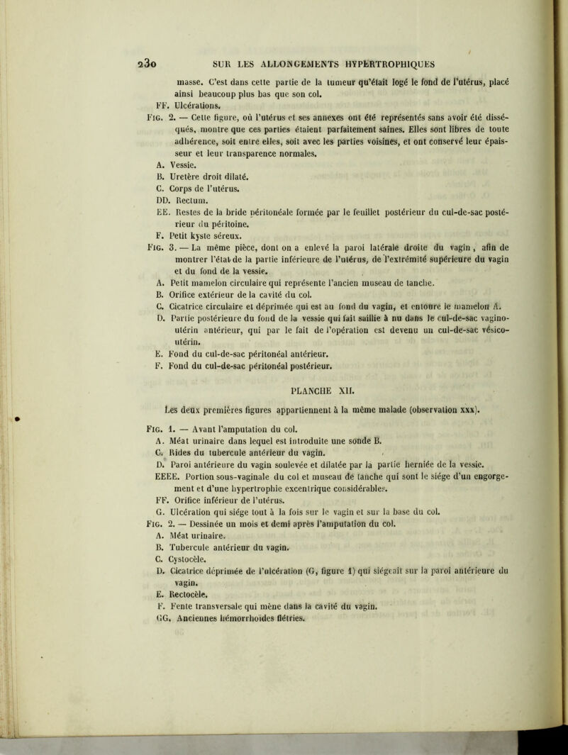 masse. C’est dans cette partie de la tumeur qu’était logé le fond de l’utérus, placé ainsi beaucoup plus bas que son col. FF. Ulcérations, Fig. 2. — Cette figure, où l’utérus et ses annexes ont été représentés sans avoir été dissé- qués, montre que ces parties étaient parfaitement saines. Elles sont libres de toute adhérence, soit entre elfes, soit avec les parties voisines, et ont conservé leur épais- seur et leur transparence normales. A. Vessie. B. Uretère droit dilaté. C. Corps de l’utérus. DD. Rectum. EE. Restes de la bride péritonéale formée par le feuillet postérieur du cul-de-sac posté- rieur du péritoine. F. Petit kyste séreux. Fig. 3. — La même pièce, dont on a enlevé la paroi latérale droite du vagin, afin de montrer l’état de la partie inférieure de l’utérus, de l’extrémité supérieure du vagin et du fond de la vessie. A. Petit mamelon circulaire qui représente l’ancien museau de tanche. B. Orifice extérieur delà cavité du col. C. Cicatrice circulaire et déprimée qui est au fond du vagin, et entoure le mamelon A. D. Partie postérieure du fond de la vessie qui fait saillie à nu dans le cul-de-sac vagino- utérin antérieur, qui par le fait de l’opération est devenu un cul-de-sac vésico- utérin. E. Fond du cul-de-sac péritonéal antérieur. F. Fond du cul-de-sac péritonéal postérieur. PLANCHE XII. Les deux premières figures appartiennent à la même malade (observation xxx). Fig. 1. — Avant l’amputation du col. A. Méat urinaire dans lequel est introduite une sonde B. C, Rides du tubercule antérieur du vagin. D. Paroi antérieure du vagin soulevée et dilatée par la partie herniée de la vessie. EEEE. Portion sous-vaginale du col et museau de tanche qui sont le siège d’un engorge- ment et d’une hypertrophie excentrique considérables. FF. Orifice inférieur de l’utérus. G. Ulcération qui siège tout à la fois sur le vagin et sur la base du col. Fig. 2. — Dessinée un mois et demi après l’amputation du col. A. Méat urinaire. B. Tubercule antérieur du vagin. C. Cystocèle. D. Cicatrice déprimée de l’ulcération (G, figure 1) qui siégeait sur la paroi antérieure du vagin. E. Rectocèle. F. Fente transversale qui mène dans la cavité du vagin. GG, Anciennes hémorrhoides flétries,