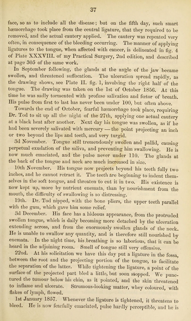 face, so as to include all the disease; but on the fifth day, such smart haemorrhage took place from the central ligature, that they required to be removed, and the actual cautery applied. The cautery was repeated very often, in consequence of the bleeding occurring. The manner of applying ligatures to the tongue, when affected with cancer, is delineated in fig. 4 of Plate XXXVIII. of my Practical Surgery, 2nd edition, and described at page 305 of the same work. In September following, the glands at the angle of the jaw became swollen, and threatened suffocation. The idceration spread rapidly, as the drawing shows, see Plate II. fig. 1, involving the right half of the tongue. The drawing was taken on the 1st of October 1856. At this time he was sadly tormented with profuse salivation and fcetor of breath. His pulse from first to last has never been under 100, but often above. Towards the end of October, fearful haemorrhage took place, requiring Dr. Tod to sit up all the night of the 27th, applying one actual cautery at a black heat after anotlier. Next day his tongue was swollen, as if he had been severely salivated with mercury—the point projecting an inch or two beyond the lips and teeth, and very turgid. 3d November. Tongue still tremendously swollen and pallid, causing perpetual exudation of the saliva, and preventing him swallowing. He is now much emaciated, and the pulse never under 110. The glands at the back of the tongue and neck are much increased in size. 10th November. His tongue now projects beyond his teeth fully two inches, and he cannot retract it. The teeth are beginning to indent them- selves in the soft tongue, and threaten to cut it in two. His existence is now kept up, more by nutrient enemata, than by nourishment from the mouth, the difficultv of swallowinsr is so distressinor. 19th. Dr. Tod nipped, with the bone pliers, the upper teeth parallel with the gum, which gave him some relief. 3d December. His face has a hideous appearance, from the protruded swollen tongue, which is daily becoming more detached by the ulceration extending across, and from the enormously swollen glands of the neck. He is unable to swallow any quantity, and is therefore still nourished by enemata. In the night time, his breathing is so laborious, that it can be heard in the adjoining room. Smell of tongue still very offensive. 22nd. At his solicitation we have this day put a ligature in the fossa between the root and the projecting portion of the tongue, to facilitate the separation of the latter. While tightening the ligature, a point of the surface of the projected part bled a little, but soon stopped. We punc- tured the tumour below his chin, as it pointed, and the skin threatened to inflame and ulcerate. Strumous-looking matter, whey coloured, with flakes of lymph, flowed. 1st January 1857. Whenever the ligature is tightened, it threatens to bleed. He is now fearfully emaciated, pulse hardly perceptible, and he is