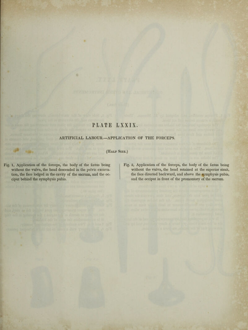 ARTIFICIAL LABOUR.—APPLICATION OF THE FORCEPS. (Half Size.) Fig. 1, Application of the forceps, the body of the foetus being without the vulva, the head descended in the pelvic excava- tion, the face lodged in the cavity of the sacrum, and the oc- ciput behind the symphysis pubis. Fig. 2, Application of the forceps, the body of the foetus being without the vulva, the head retained at the superior strait, the face directed backward, and above the symphysis pubis, and the occiput in front of the promontory of the sacrum.