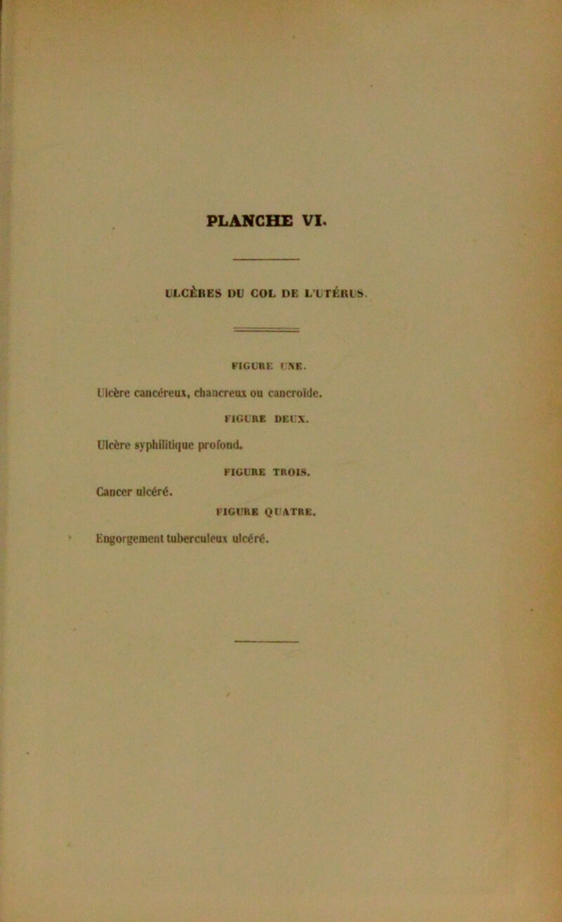 ULCÊBES DU COL DE L’UTÉRL!>. FiGURi: r.%e. Ulcère cancéreux, chancreux ou cancroWc. l'IGtRE DEUX. Ulcère syphilitique profond. Cancer ulcéré. FIGURE TROIS. FIGURE QUATRE. Engorgement tuberculeux ulcéré.