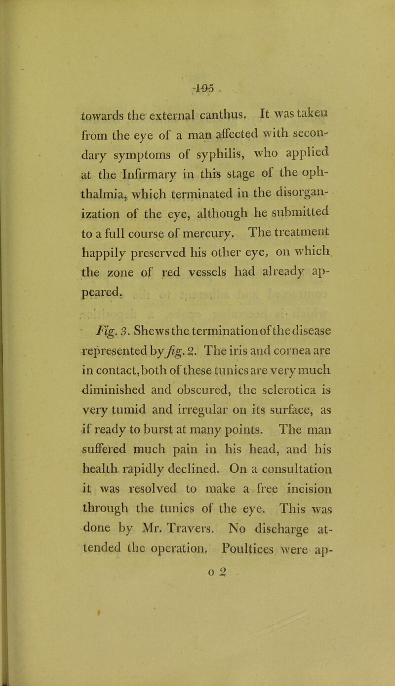 -105 . towards the external canthus. It was taken from the eye of a man affected with secon- dary symptoms of syphilis, who applied at the Infirmary in this stage of the oph- thalmia^ which terminated in the disorgan- ization of the eye, although he submitted to a full course of mercury. The treatment happily preserved his other eye, on which the zone of red vessels had already ap- peared, Fig. 3. Shews the termination of the disease represented by Jig. 2. The iris and cornea are in contact, both of these tunics are very much diminished and obscured, the sclerotica is very tumid and irregular on its surface, as if ready to burst at many points. The man suffered much pain in his head, and his healtk rapidly declined. On a consultation it was resolved to make a free incision through the tunics of the eye. This was done by Mr. Travers. No discharge at- tended the operation. Poultices were ap- o 5