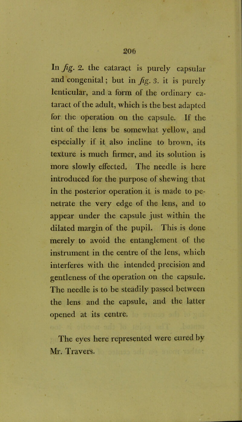 In jig. % the cataract is purely capsular and congenital; but in jig. 3. it is purely lenticular, and a form of the ordinary ca- taract of the adult, which is the best adapted for the operation on the capsule. If the tint of the lens be somewhat yellow, and especially if it also incline to brown, its texture is much firmer, and its solution is more slowly effected. The needle is here introduced for the purpose of shewing that in the posterior operation it is made to pe- netrate the very edge of the lens, and to appear under the capsule just within the dilated margin of the pupil. This is done merely to avoid the entanglement of the instrument in the centre of the lens, which interferes with the intended precision and gentleness of the operation on the capsule. The needle is to be steadily passed between the lens and the capsule, and the latter opened at its centre. The eyes here represented were cured by Mr. Travers.