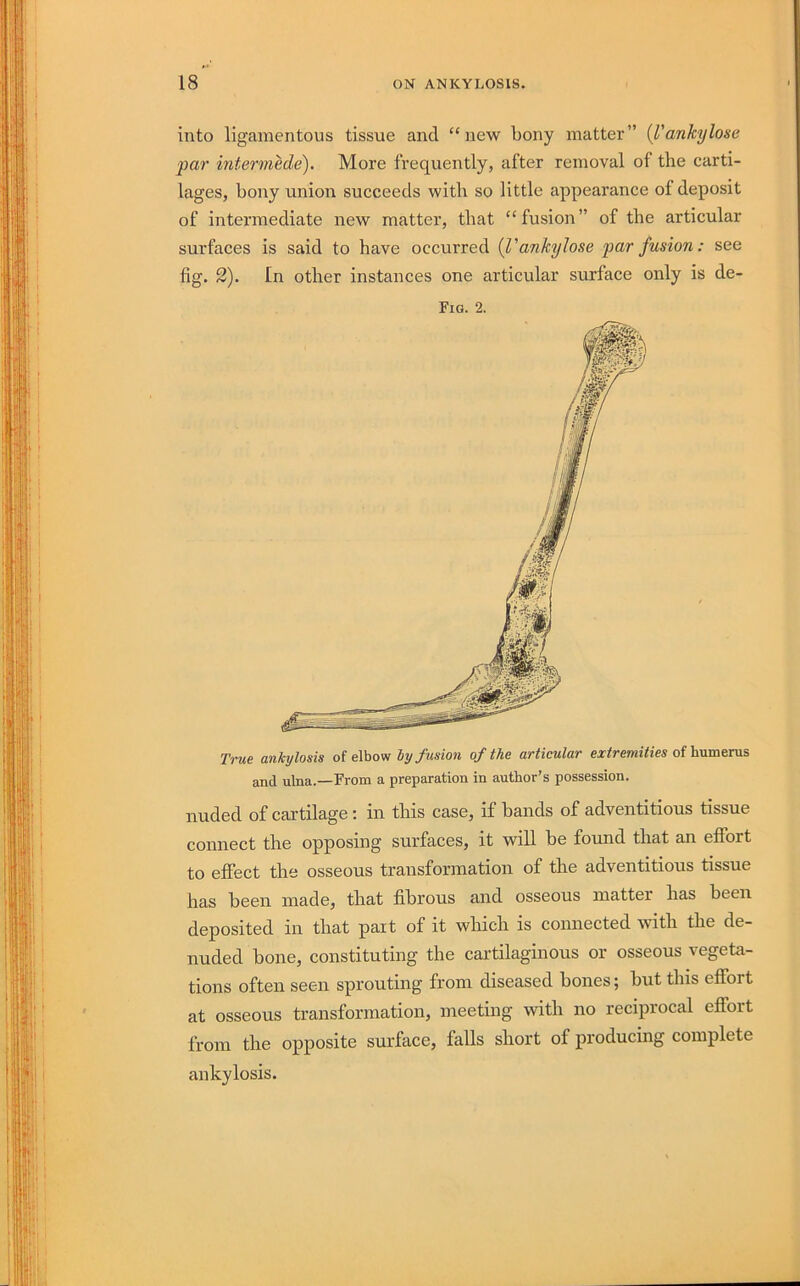 into ligamentous tissue and “new bony matter” {Vankylose par intermede). More frequently, after removal of the carti- lages, bony union succeeds with so little appearance of deposit of intermediate new matter, that “fusion” of the articular surfaces is said to have occurred {I'ankylose j)ar fusion: see fig. 2). In other instances one articular surface only is de- Fig. 2. T7-ue ankylosis of elbow hy fusion of the articular extremities of humerus and ulna.—From a preparation in author’s possession. nuded of cartilage; in this case, if bands of adventitious tissue connect the opposing surfaces, it will be formd that an effort to effect the osseous transformation of the adventitious tissue has been made, that fibrous and osseous matter has been deposited in that part of it which is connected with the de- nuded bone, constituting the cartilaginous or osseous vegeta- tions often seen sprouting from diseased bones; but this effort at osseous transformation, meeting with no reciprocal effort from the opposite surface, falls short of producing complete ankylosis.