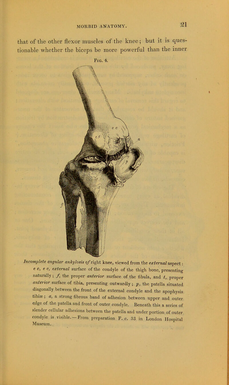 that of the other flexor muscles of the knee; hut it is ques- tionable whether the biceps be more powerful than the inner Fig. 4. Incomplete angular ankylosis 0/right knee, viewed from the external : e c, e c, external surface of the condyle of the thigh bone, presenting naturally; /, the proper anterior surface of the fibula, and proper anterior surface of tibia, presenting outwardly ; p, the patella situated diagonaUy between the front of the external condyle and the apophysis tibise; a, a strong fibrous band of adhesion between upper and outer edge of the patella and front of outer condyle. Beneath this a series of slender cellular adhesions between the patella and under portion of outer condyle is visible. —From preparation F. c. 33 in London Hospital Museum.