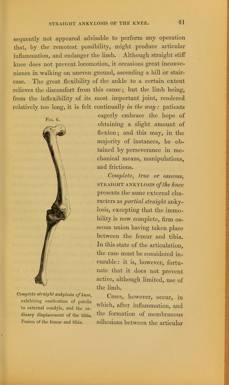 sequently not appeared advisable to perform any operation that, by the remotest possibility, might produce articular inflammation, and endanger the limb. Although straight stiff knee does not prevent locomotion, it occasions great inconve- nience in walking on uneven ground, ascending a hill or stair- case. The great flexibility of the ankle to a certain extent relieves the discomfort from this cause; but the limb being. from the inflexibility of its relatively too long, it is felt Fig. 6. Complete straight ankylosis of knee, exhibiting ossification of patella to external condyle, and the or- dinary displacement of the tibia. Fusion of the femur and tibia. most important joint, rendered continually in the way: patients eagerly embrace the hope of obtaining a slight amount of flexion; and this may, in the majority of instances, be ob- tained by perseverance in me- chanical means, manipulations, and frictions. Complete, true or osseous, STRAIGHT ANKYLOSIS ofthe knee presents the same external cha- racters as partial straight anky- losis, excepting that the immo- bility is now complete, firm os- seous union having taken place between the femur and tibia. In this state of the articulation, the case must be considered in- curable: it is, however, fortu- nate that it does not prevent active, although limited, use of the limb. Cases, however, occur, in which, after inflammation, and the formation of membranous adhesions between the articular