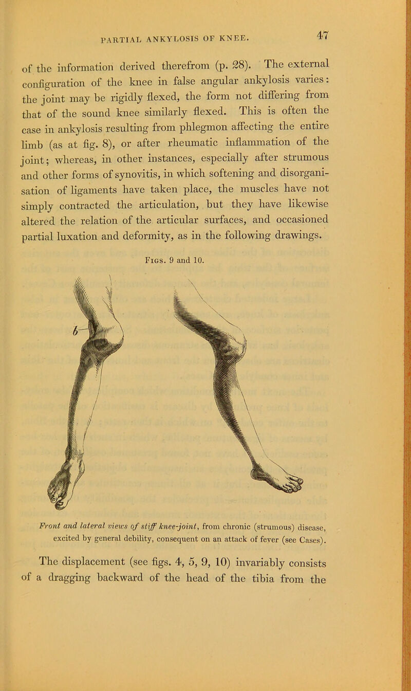 of the information derived therefrom (ii. 28). The external config-m-ation of the knee in false angular ankylosis varies: the joint may be rigidly flexed, the form not differing from tliat of the sound knee similarly flexed. This is often the case in ankylosis resulting from phlegmon affecting the entire limb (as at fig. 8), or after rheumatic inflammation of the joint; whereas, in other instances, especially after strumous and other forms of synovitis, in which softening and disorgani- sation of ligaments have taken place, the muscles have not simply contracted the articulation, but they have likevrise altered the relation of the articular surfaces, and occasioned partial luxation and deformity, as in the following drawings. Figs. 9 and 10. Front and lateral views of stiff knee-joint, from chronic (strumous) disease, excited by general debility, consequent on an attack of fever (see Cases). The displacement (see figs. 4, 5, 9, 10) invariably consists of a dragging backward of the head of the tibia from the