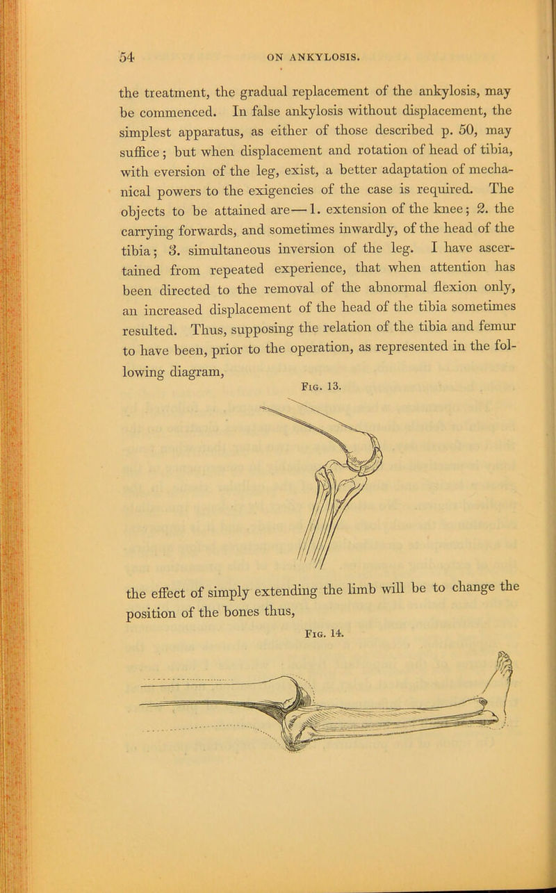 the treatment, the gradual replacement of the ankylosis, may he commenced. In false ankylosis without displacement, the simplest apparatus, as either of those described p. 50, may suffice ; but when displacement and rotation of head of tibia, with eversion of the leg, exist, a better adaptation of mecha- nical powers to the exigencies of the case is required. The objects to be attained are—1. extension of the knee; 2. the carrying forwards, and sometimes inwardly, of the head of the tibia; S. simultaneous inversion of the leg. I have ascer- tained from repeated experience, that when attention has been directed to the removal of the abnormal flexion only, an increased displacement of the head of the tibia sometimes resulted. Thus, supposing the relation of the tibia and femur to have been, prior to the operation, as represented in the fol- lowing diagram. Fig. 13. the effect of simply extending the limb will be to change the position of the bones thus. Fig. 14.