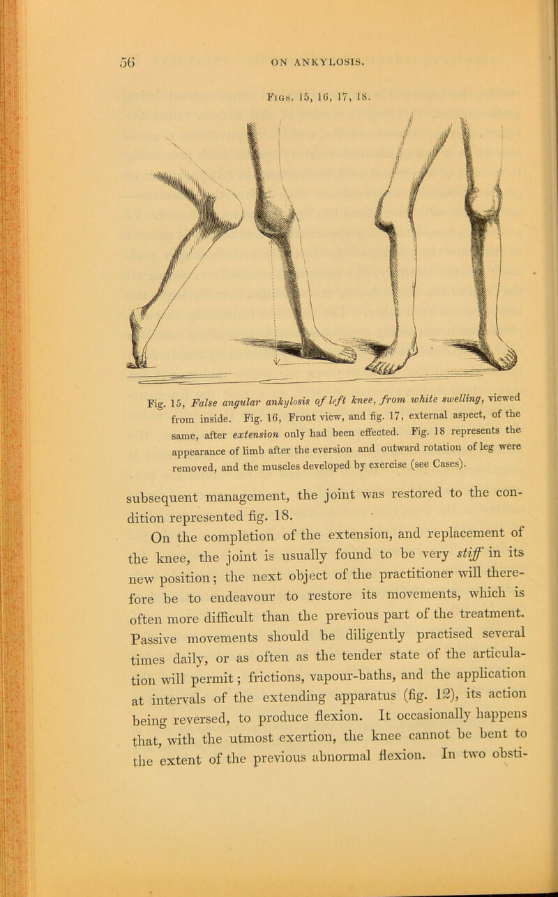 Fig. 15, False angular ankylosis of left knee, from white swelling, viewed from inside. Fig. 16, Front view, and fig. 17, external aspect, of the same, after extension only had been effected. Fig. 18 represents the appearance of limb after the eversion and outward rotation of leg were removed, and the muscles developed by exercise (see Cases). subsequent management, the joint was restored to the con- dition represented fig. 18. On the completion of the extension, and replacement of the knee, the joint is usually found to he very stiff in its new position; the next object of the practitioner will there- fore be to endeavour to restore its movements, which is often more difficult than the previous part of the treatment. Passive movements should be diligently practised several times daily, or as often as the tender state of the articula- tion will permit; frictions, vapour-baths, and the application at intervals of the extending apparatus (fig. 12), its action being reversed, to produce flexion. It occasionally happens that, with the utmost exertion, the knee cannot be bent to the extent of the previous abnormal flexion. In two obsti-