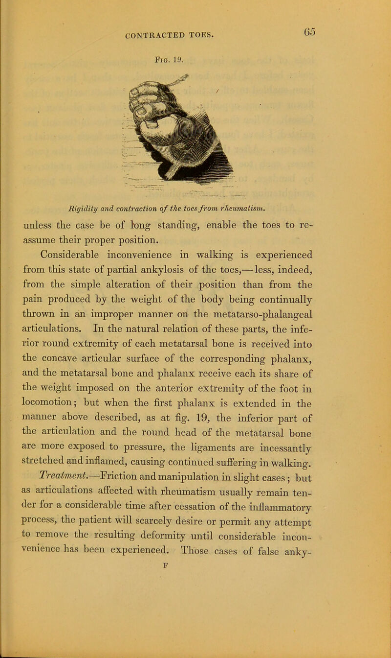 Fig. 1.9. Rigidity and contraction of the toes from rheumatism. unless the case be of long standing, enable the toes to re- assume their proper position. Considerable inconvenience in walking is experienced from this state of partial ankylosis of the toes,— less, indeed, from the simple alteration of their position than from the pain produced by the weight of the body being continually thrown in an improper manner on the metatarso-phalangeal articulations. In the natural relation of these parts, the infe- rior round extremity of each metatarsal bone is received into the concave articular surface of the corresponding phalanx, and the metatarsal bone and phalanx receive each its share of the weight imposed on the anterior extremity of the foot in locomotion; but when the first phalanx is extended in the manner above described, as at fig. 19, the inferior part of the articulation and the round head of the metatarsal bone are more exposed to pressure, the ligaments are incessantly stretched and infiamed, causing continued suffering in walking. Treatment.—Friction and manipulation in slight cases; but as articulations affected with rheumatism usually remain ten- der for a considerable time after cessation of the inflammatory process, the patient will scarcely desire or permit any attempt to remove the resulting deformity until considerable incon- venience has been experienced. Those cases of false anky- F