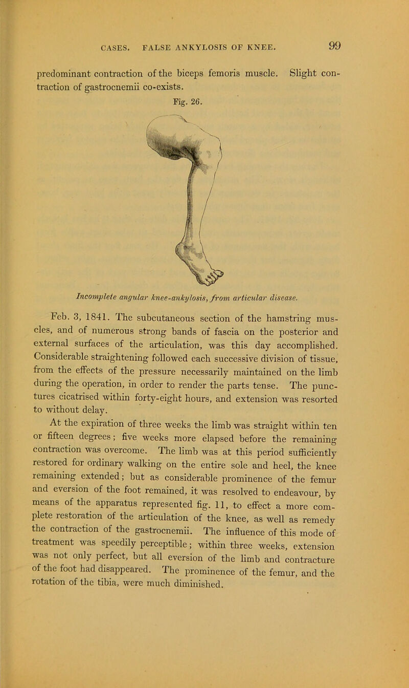 predominant contraction of the biceps femoris muscle. Slight con- traction of gastrocnemii co-exists. Fig. 26. Incomplete angular knee-ankylosis, from articular disease. Feb. 3, 1841. The subcutaneous section of the hamstring mus- cles, and of numerous strong bands of fascia on the posterior and external surfaces of the articulation, was this day accomplished. Considerable straightening followed each successive division of tissue, from the effects of the pressure necessarily maintained on the limb during the operation, in order to render the parts tense. The jiunc- tures cicatrised within forty-eight hours, and extension was resorted to without delay. At the expiration of three weeks the limb was straight within ten or fifteen degrees; five weeks more elapsed before the remaining contraction was overcome. The limb was at this period sufficiently restored for ordinary walking on the entire sole and heel, the knee remaining extended; but as considerable prominence of the femur and eversion of the foot remained, it was resolved to endeavour, by means of the apparatus represented fig. 11, to effect a more com- plete restoration of the articulation of the knee, as well as remedy the contraction of the gastrocnemii. The influence of this mode of treatment was speedily perceptible; within three weeks, extension was not only perfect, but all eversion of the limb and contracture of the foot had disappeared. The prominence of the femur, and the rotation of the tibia, were much diminished.