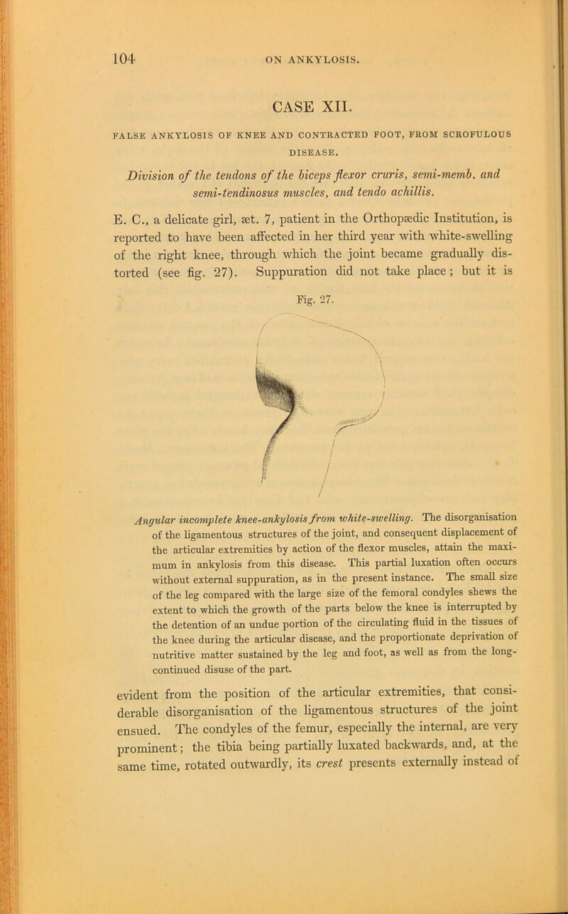 CASE XII. FALSE ANKYLOSIS OF KNEE AND CONTRACTED FOOT, FROM SCROFULOUS DISEASE. Division of the tendons of the biceps flexor cruris, semi-memh. and semi-tendinosus muscles, and tendo achillis. E. C., a delicate girl, set. 7, patient in the Orthopsedic Institution, is reported to have been affected in her third year with white-swelling of the right knee, through which the joint became gradually dis- torted (see fig. 27). Suppuration did not take place; but it is Fig. 27. f / F Angular incomplete knee-ankylosis from white-swelling. The disorganisation of the ligamentous structures of the joint, and consequent displacement of the articular extremities by action of the flexor muscles, attahi the maxi- mum in ankylosis from this disease. This partial luxation often occurs without external suppuration, as in the present instance. The small size of the leg compared with the large size of the femoral condyles shews the extent to which the growth of the parts below the knee is interrupted by the detention of an undue portion of the circulating fluid in the tissues of the knee during the articular disease, and the proportionate deprivation of nutritive matter sustained by the leg and foot, as well as from the long- continued disuse of the part. evident from the position of the articular extremities, that consi- derable disorganisation of the ligamentous structures of the joint ensued. The condyles of the femur, especially the internal, are verj’^ prominent; the tibia being partially luxated backwards, and, at the same time, rotated outwardly, its crest presents externally instead of