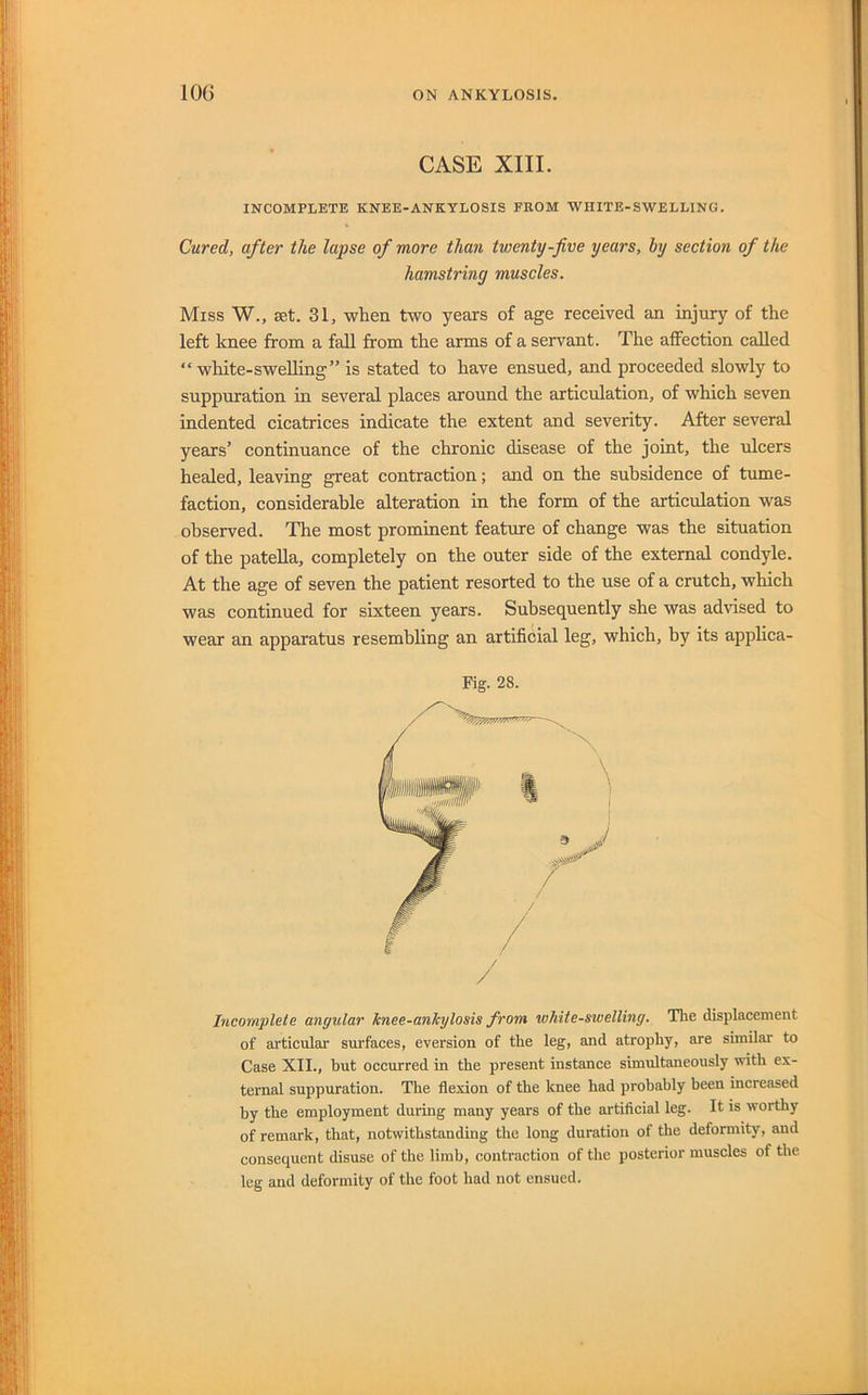 CASE XIII. INCOMPLETE KNEE-ANKYLOSIS FKOM WHITE-SWELLING. Cured, after the lapse of more than twenty-five years, by section of the hamstring muscles. Miss W., set. 31, when two years of age received an injury of the left knee from a fall from the arms of a servant. The affection called “white-swelling” is stated to have ensued, and proceeded slowly to suppuration in several places around the articulation, of which seven indented cicatrices indicate the extent and severity. After several years’ continuance of the chronic disease of the joint, the ulcers healed, leaving great contraction; and on the subsidence of tume- faction, considerable alteration in the form of the articulation was observed. The most prominent feature of change was the situation of the patella, completely on the outer side of the external condyle. At the age of seven the patient resorted to the use of a crutch, which was continued for sixteen years. Subsequently she was advised to wear an apparatus resembling an artificial leg, which, by its applica- Fig. 28. Incomplete angular knee-ankylosis from white-swelling. The displacement of articular surfaces, eversion of the leg, and atrophy, are similar to Case XII., but occurred in the present instance simultaneously with ex- ternal suppuration. The flexion of the knee had probably been increased by the employment during many years of the artificial leg. It is worthy of remark, that, notwithstanding the long duration of the deformity, and consequent disuse of the limb, contraction of the posterior muscles of the leg and deformity of the foot had not ensued.