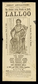 [Undated handbill (1891? printed in Glasgow) advertising an exhibition of the conjoined twin, Lalloo, a 17 year old Indian boy and his twin (growing out of his breastbone)].