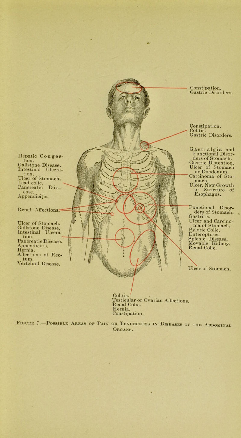 Gastric Disorders. Colitis. Testicular or Ovarian Affections. Renal Colic. Hernia. Constipation. Hepatic Conges- tion. Gallstone Disease. Intestinal Ulcera- tion. Ulcer of Stomach. Lead colic. Pancreatic Dis- ease. Appendicitis. Renal I Ulcer of Stomach. Gallstone Disease. Intestinal Ulcera- tion. Pancreatic Disease. Appendicitis. Hernia. Affections of Rec- tum. Vertebral Disease. Constipation. Colitis. Gastric Disorders. Gastralgia and Functional Disor- ders of Stomach. Gastric Distention. Ulcer of Stomach or Duodenum. Carcinoma of Sto- mach. Ulcer, New Growth or Stricture of Esophagus. al Disor- ders of Stomach. Gastritis. Ulcer and Carcino- ma of Stomach. Pyloric Colic. Enteroptosis. Splenic Disease. Movable Kidney. Renal Colic. Ulcer of Stomach. Figure 7.—Possible Areas of Pain or Tenderness in Diseases of the Abdominal Organs.