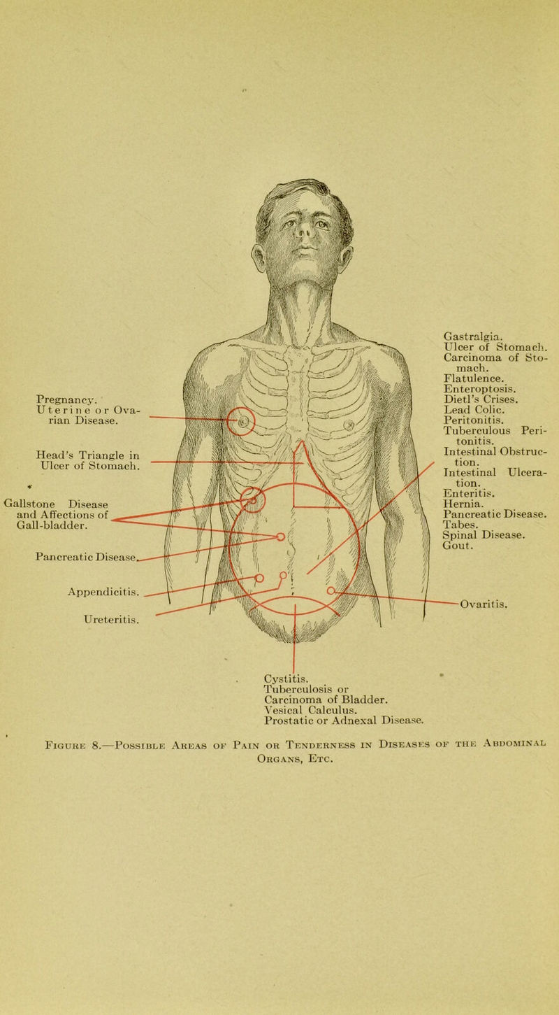 Cystitis. Tuberculosis or Carcinoma of Bladder. Vesical Calculus. Prostatic or Adnexal Disease. Figure 8.—Possible Areas of Pain or Tenderness in Diseases of the Abdominal Organs, Etc. Gastralgia. Ulcer of Stomach. Carcinoma of Sto- mach. Flatulence. Enteroptosis. Dietl’s Crises. Lead Colic. Peritonitis. Tuberculous Peri- tonitis. Intestinal Obstruc- tion. Intestinal Ulcera- tion. Enteritis. Hernia. Pancreatic Disease. Tabes. Spinal Disease. Gout. Appendicitis. Ureteritis. Ovaritis. Pregnancy. Uterine or Ova- rian Disease. Pancreatic Disease Head’s Triangle in Ulcer of Stomach. Gallstone Disease and Affections of Gall-bladder.