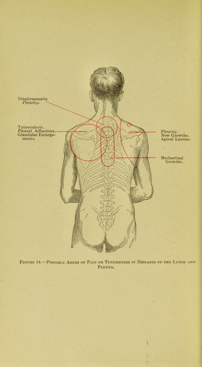 Diaphragmatic Pleurisy. Tuberculosis. Pleural Adhesions. Glandular Enlarge- ments. Pleurisy. New Growths. Apical Lesions. Mediastinal Growths. Figure 14.—Possible Areas of Pain or Tenderness in Diseases of the Lungs and Pleura.