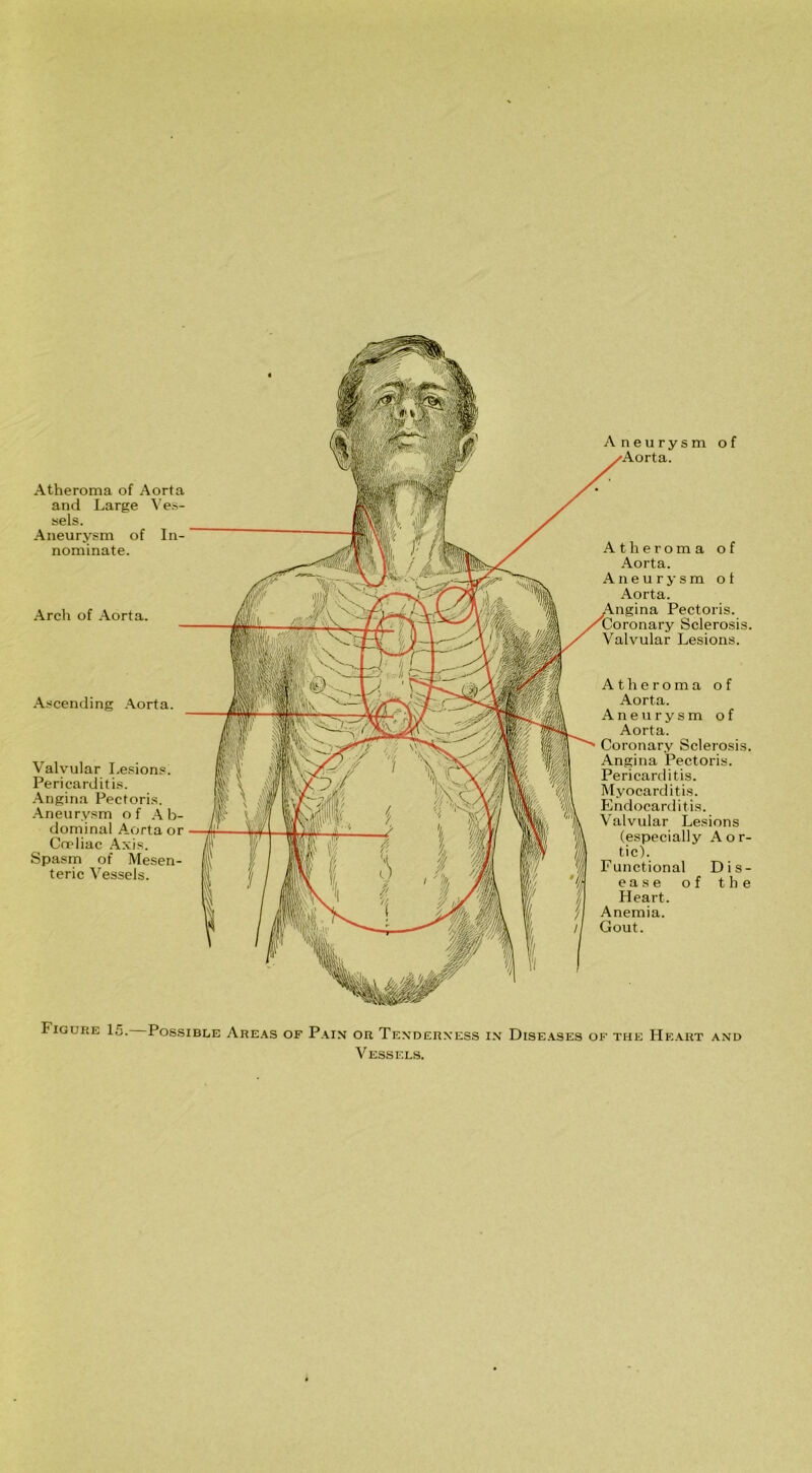 and Large Ves- sels. Aneurysm of In- nominate. Arch of Aorta. Atheroma of Aorta. Aneurysm ot Aorta. Pectoris, ronary Sclerosis. Valvular Lesions. Ascending Aorta. Atheroma of Aorta. Aneurysm of Aorta. Coronary Sclerosis. Angina Pectoris. Pericarditis. Myocarditis. Endocarditis. Valvular Lesions (especially Aor- tic). Functional Dis- ease of the Heart. Anemia. Gout. Valvular Lesions. Pericarditis. Angina Pectoris. Aneurysm of Ab- dominal Aorta or Cneliac Axis. Spasm of Mesen- teric Vessels. Figure 15. Possible Areas of Pain or Tenderness in Diseases of the Heart and