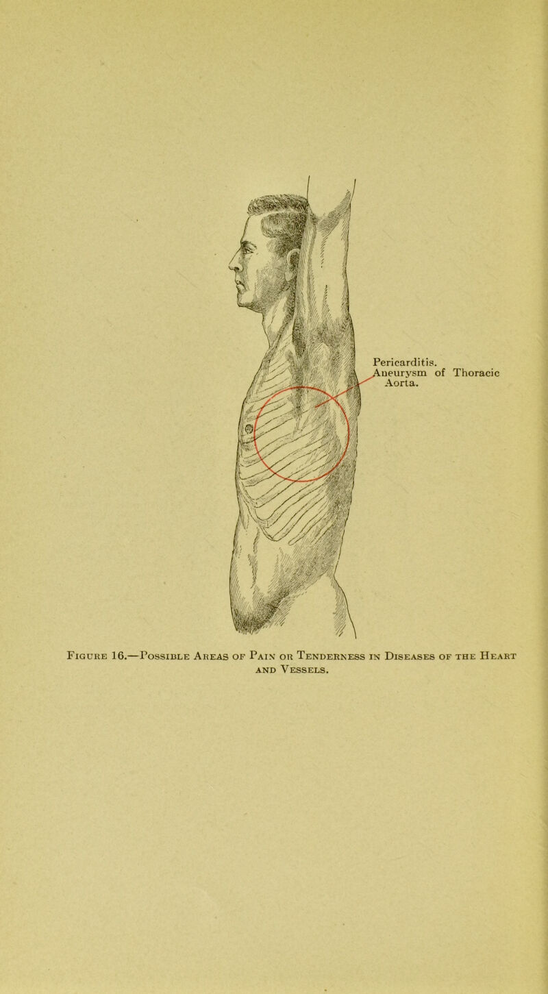 Pericarditis, ueurysm of Thoracic Aorta. Figure 16.—Possible Areas of Pain or Tenderness in Diseases of the Heart