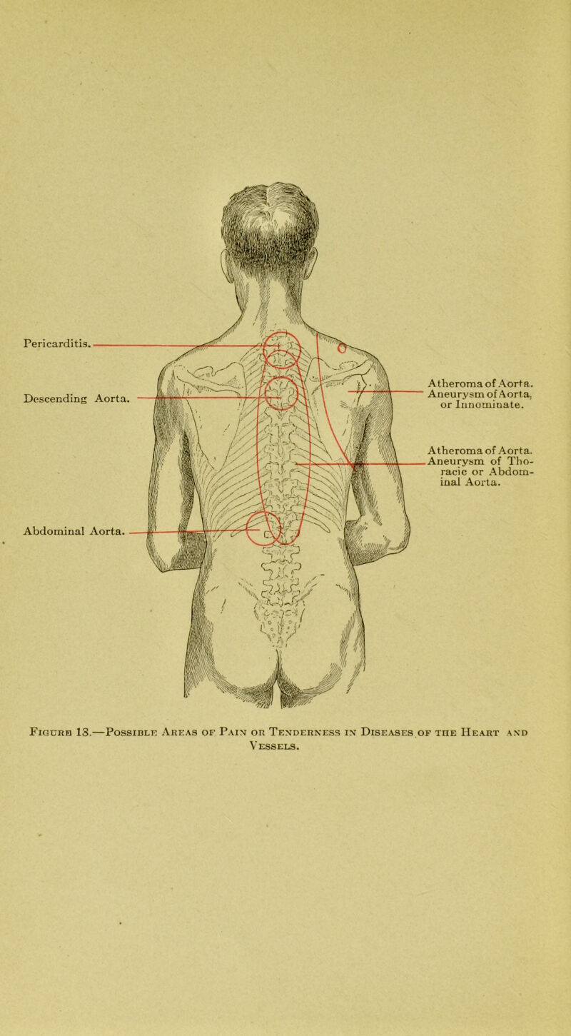 Abdominal Aorta. Descending Aorta. Aneurysm of Aort a,, or Innominate. Aneurysm of Tho- racic or Abdom- inal Aorta. Figure 13.—Possible Areas of Pain or Tenderness in Diseases of tiie Heart and