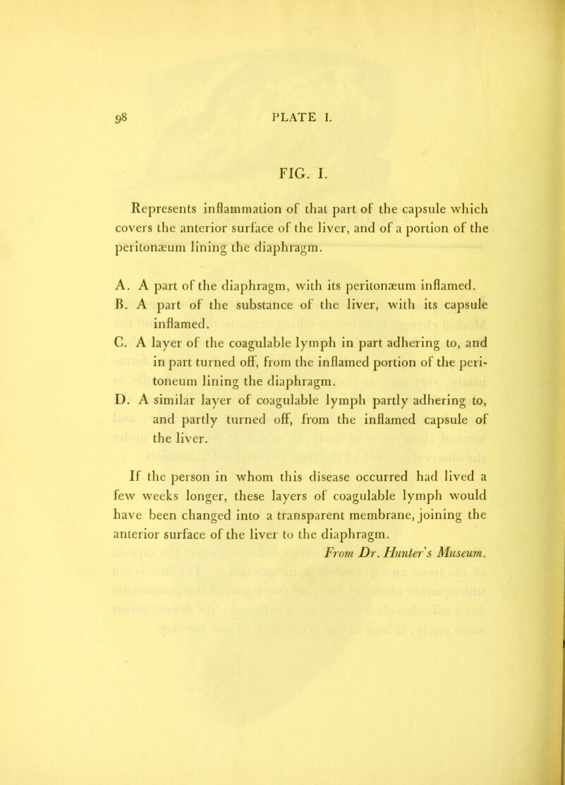 FIG. I. Represents inflammation of that part of the capsule which covers the anterior surface of the liver, and of a portion of the peritonaeum lining the diaphragm. A. A part of the diaphragm, with its peritonaeum inflamed. B. A part of the substance of the liver, with its capsule inflamed. C. A layer of the coagulable lymph in part adhering to, and in part turned off, from the inflamed portion of the peri- toneum lining the diaphragm. D. A similar layer of coagulable lymph partly adhering to, and partly turned off, from the inflamed capsule of the liver. If the person in whom this disease occurred had lived a few weeks longer, these layers of coagulable lymph would have been changed into a transparent membrane, joining the anterior surface of the liver to the diaphragm. From Dr. Hunter s Museum.