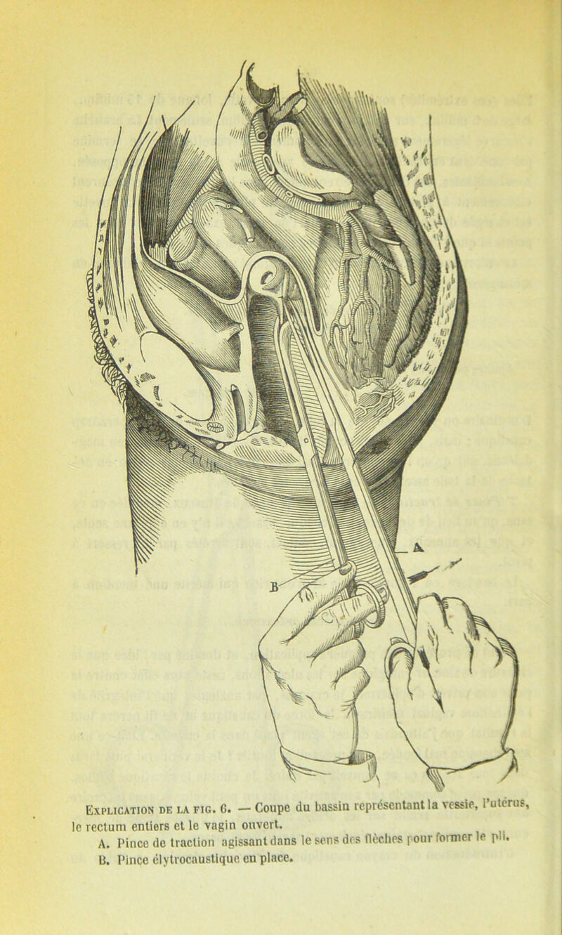 Explication de la fig. C. — Coupe du bassin représentant la vessie, l’utérus, le rectum entiers et le vagin ouvert. A. Pince de traction agissant dans le sens des flèches pour former le pi. ü. Pince élytrocaustique en place.