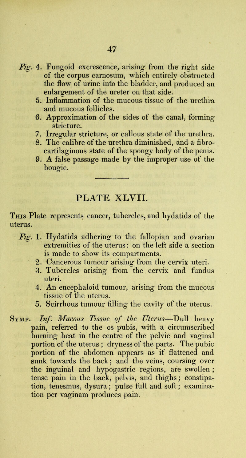 Fig. 4. Fungoid excrescence, arising from the right side of the corpus carnosum, which entirely obstructed the flow of urine into the bladder, and produced an enlargement of the ureter on that side. 5. Inflammation of the mucous tissue of the urethra and mucous follicles. 6. Approximation of the sides of the canal, forming stricture. 7. Irregular stricture, or callous state of the urethra. 8. The calibre of the urethra diminished, and a fibro- cartilaginous state of the spongy body of the penis. 9. A false passage made by the improper use of the bougie. PLATE XLYII. This Plate represents cancer, tubercles, and hydatids of the uterus. Fig. 1. Hydatids adhering to the fallopian and ovarian extremities of the uterus: on the left side a section is made to show its compartments. 2. Cancerous tumour arising from the cervix uteri. 3. Tubercles arising from the cervix and fundus uteri. 4. An encephaloid tumour, arising from the mucous tissue of the uterus. 5. Scirrhous tumour filling the cavity of the uterus. Symp. Inf. Mucous Tissue of the Uterus—Dull heavy pain, referred to the os pubis, with a circumscribed burning heat in the centre of the pelvic and vaginal portion of the uterus; dryness of the parts. The pubic portion of the abdomen appears as if flattened and sunk towards the back; and the veins, coursing over the inguinal and hypogastric regions, are swollen ; tense pain in the back, pelvis, and thighs; constipa- tion, tenesmus, dysura; pulse full and soft; examina- tion per vaginam produces pain.