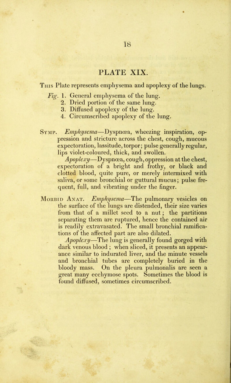 PLATE XIX. This Plate represents emphysema and apoplexy of the lungs. Fig. 1. General emphysema of the lung. 2. Dried portion of the same lung. 3. Diffused apoplexy of the lung. 4. Circumscribed apoplexy of the lung. Symp. Emphysema—Dyspnoea, wheezing inspiration, op- pression and stricture across the chest, cough, mucous expectoration, lassitude, torpor; pulse generally regular, lips violet-coloured, thick, and swollen. Apoplexy—Dyspnoea, cough, oppression at the chest, expectoration of a bright and frothy, or black and clotted blood, quite pure, or merely intermixed with saliva, or some bronchial or guttural mucus; pulse fre- quent, full, and vibrating under the linger. Morbid Anat. Emphysema—The pulmonary vesicles on the surface of the lungs are distended, their size varies from that of a millet seed to a nut; the partitions separating them are ruptured, hence the contained air is readily extravasated. The small bronchial ramifica- tions of the affected part are also dilated. Apoplexy—The lung is generally found gorged with dark venous blood ; when sliced, it presents an appear- ance similar to indurated liver, and the minute vessels and bronchial tubes are completely buried in the bloody mass. On the pleura pulmonalis are seen a great many ecchymose spots. Sometimes the blood is found diffused, sometimes circumscribed.