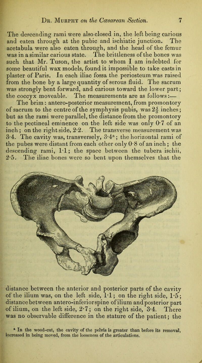 The descending rarai were also closed in, the left being carious and eaten through at the pubic and ischiatic junction. The acetabula were also eaten through, and the head of the femur was in a similar carious state. The brittleness of the bones was such that Mr. Tuson, the artist to whom I am indebted for some beautiful wax models, found it impossible to take casts in plaster of Paris. In each iliac fossa the periosteum was raised from the bone by a large quantity of serous fluid. The sacrum was strongly bent forward, and carious toward the lower part; the coccyx moveable. The measurements are as follows:— The brim: antero-posterior measurement, from promontory of sacrum to the centre of the symphysis pubis, was inches; but as the rami were parallel, the distance from the promontory to the pectineal eminence on the left side was only 0*7 of an inch ; on the right side, 2*2. The transverse measurement was 3*4. The cavity was, transversely, 3*4*^; the horizontal rami of the pubes were distant from each other only 0*8 of an inch ; the descending rami, 1*1; the space between the tubera ischii, 2*5. The iliac bones were so bent upon themselves that the distance between the anterior and posterior parts of the cavity of the ilium was, on the left side, 1*1; on the right vside, 1*5; distancebetween an tero-inferior spine of ilium and posterior part of ilium, on the left side, 2*7; on the right side, 3*4. There was no observable difference in the stature of the patient; the ® In the wood-cut, the cavity of the pelvis is greater than before its removal, increased in being moved, from the looseness of the articulations.