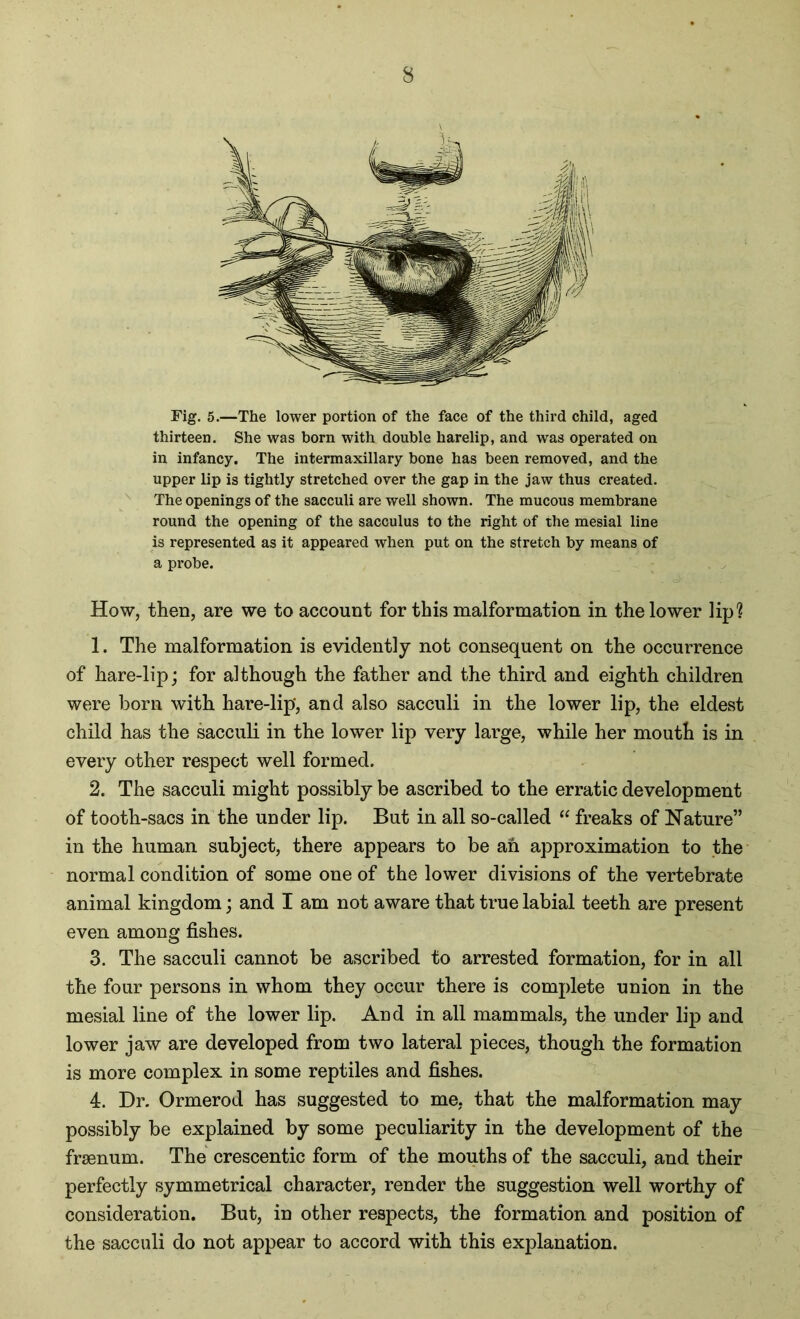 Fig. 5.—The lower portion of the face of the third child, aged thirteen. She was born with double harelip, and was operated on in infancy. The intermaxillary bone has been removed, and the upper lip is tightly stretched over the gap in the jaw thus created. The openings of the sacculi are well shown. The mucous membrane round the opening of the sacculus to the right of the mesial line is represented as it appeared when put on the stretch by means of a probe. How, then, are we to account for this malformation in the lower lip? 1. The malformation is evidently not consequent on the occurrence of hare-lip; for although the father and the third and eighth children were born with hare-lip*, and also sacculi in the lower lip, the eldest child has the sacculi in the lower lip very large, while her mouth is in every other respect well formed. 2. The sacculi might possibly be ascribed to the erratic development of tooth-sacs in the under lip. But in all so-called “ freaks of Nature” in the human subject, there appears to be ah approximation to the normal condition of some one of the lower divisions of the vertebrate animal kingdom; and I am not aware that true labial teeth are present even among fishes. 3. The sacculi cannot be ascribed to arrested formation, for in all the four persons in whom they occur there is complete union in the mesial line of the lower lip. And in all mammals, the under lip and lower jaw are developed from two lateral pieces, though the formation is more complex in some reptiles and fishes. 4. Dr. Ormerod has suggested to me, that the malformation may possibly be explained by some peculiarity in the development of the frsenum. The crescentic form of the mouths of the sacculi, and their perfectly symmetrical character, render the suggestion well worthy of consideration. But, in other respects, the formation and position of the sacculi do not appear to accord with this explanation.