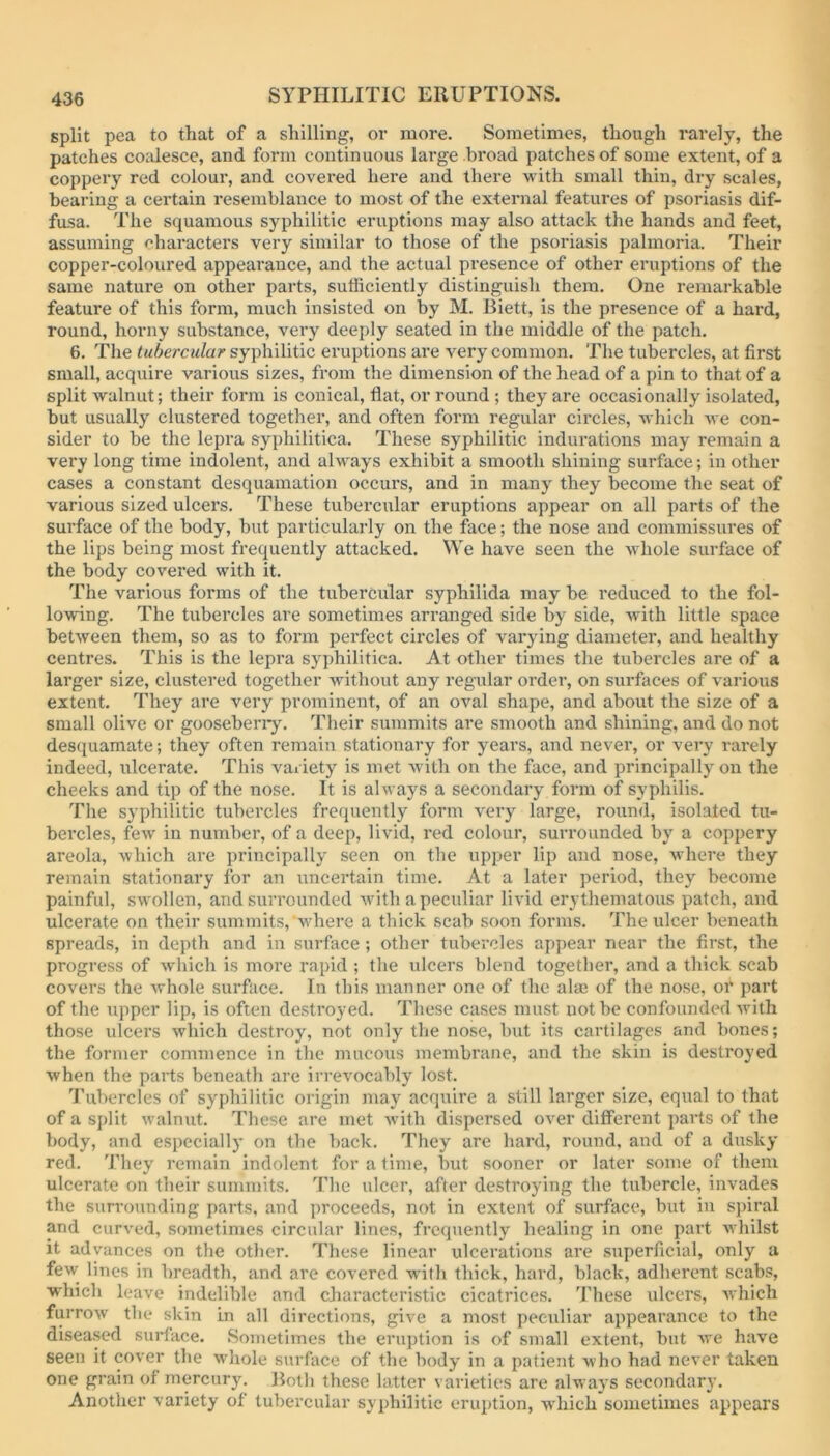 split pea to that of a shilling, or more. Sometimes, though rarely, the patches coalesce, and form continuous large broad patches of some extent, of a coppery red coloui*, and covei’ed here and there with small thin, dry scales, bearing a certain resemblance to most of the external features of psoriasis dif- fusa. The squamous syphilitic eruptions may also attack the hands and feet, assuming f’haracters very similar to those of the psoriasis palmoria. Their copper-coloured appearance, and the actual presence of other eruptions of the same nature on other parts, sufficiently distinguish them. One remarkable feature of this form, much insisted on by M. liiett, is the presence of a hard, round, horny substance, very deeply seated in the middle of the patch. 6. The tubercular syphilitic eruptions are very common. The tubercles, at first small, acquire various sizes, from the dimension of the head of a pin to that of a split walnut; their form is conical, flat, or round ; they are occasionally isolated, but usually clustered together, and often form regular circles, which Ave con- sider to be the lepra syphilitica. These syphilitic indurations may remain a very long time indolent, and always exhibit a smooth shining surface; in other cases a constant desquamation occurs, and in many they become the seat of various sized ulcei’s. These tubercular eruptions appear on all parts of the surface of the body, but particularly on the face; the nose and commissures of the lips being most frequently attacked. ^Ye have seen the whole surface of the body covered with it. The various forms of the tubercular syphilida may be reduced to the fol- lowing. The tubercles are sometimes arranged side by side, with little space hetAveen them, so as to form perfect circles of vai'ying diameter, and healthy centres. This is the lepra syphilitica. At other times the tubercles are of a larger size, clustered together Avithout any regular order, on surfaces of A arious extent. They are very prominent, of an oval shape, and about the size of a small olive or goosebeny. Their siimmits are smooth and shining, and do not desquamate; they often remain stationary for years, and never, or very rarely indeed, ulcerate. This variety is met Avith on the face, and principally on the cheeks and tip of the nose. It is always a secondary form of syphilis. The syphilitic tubercles frequently form very large, round, isolated tu- bercles, feAV in number, of a deep, livid, red colour, surrounded by a coppery areola, Avhich are principally seen on the upper lip and nose, Avhere they remain stationary for an uncertain time. At a later period, they become painful, swollen, and surrounded Avith a peculiar livid erythematous patch, and ulcerate on their summits, Avhere a thick scab soon forms. The ulcer beneath spreads, in depth and in surface ; other tubercles appear near the first, the progress of Avhich is more rapid ; the ulcers blend together, and a thick scab covers the Avhole surface. In this manner one of the ala; of the nose, or part of the upper lip, is often destroyed. These cases must not be confounded Avith those ulcers Avhich destroy, not only the nose, but its cartilages and bones; the former commence in the mucous membrane, and the skin is destroyed Avhen the parts beneath are irrevocably lost. Tubercles of syphilitic origin may acquire a still larger size, equal to that of a split Avalnut. These are met Avith dispersed over different parts of the body, and especially on the back. They are hard, round, and of a dusky red. They remain indolent for a time, but sooner or later some of them ulcerate on their summits. The ulcer, after destroying the tubercle, invades the surrounding parts, and proceeds, not in extent of surface, but in spiral and ciirved, sometimes circular lines, frequently healing in one part Avhilst it advances on the other. These linear ulcerations are superficial, only a few lines in breadth, and are covered with thick, hard, black, adherent scabs, whicli leave indelible and characteristic cicatrices. 'Fhese ulcers, Avhich furroAv the skin in all directions, give a most peculiar appearance to the diseased surface. Sometimes the eruption is of small extent, but Ave have seen it cover the Avhole surface of the body in a patient Avho had never taken one grain of mercury. Jiotb these latter varieties are always secondary. Another variety of tubercular syphilitic eruption, Avhich sometimes appears